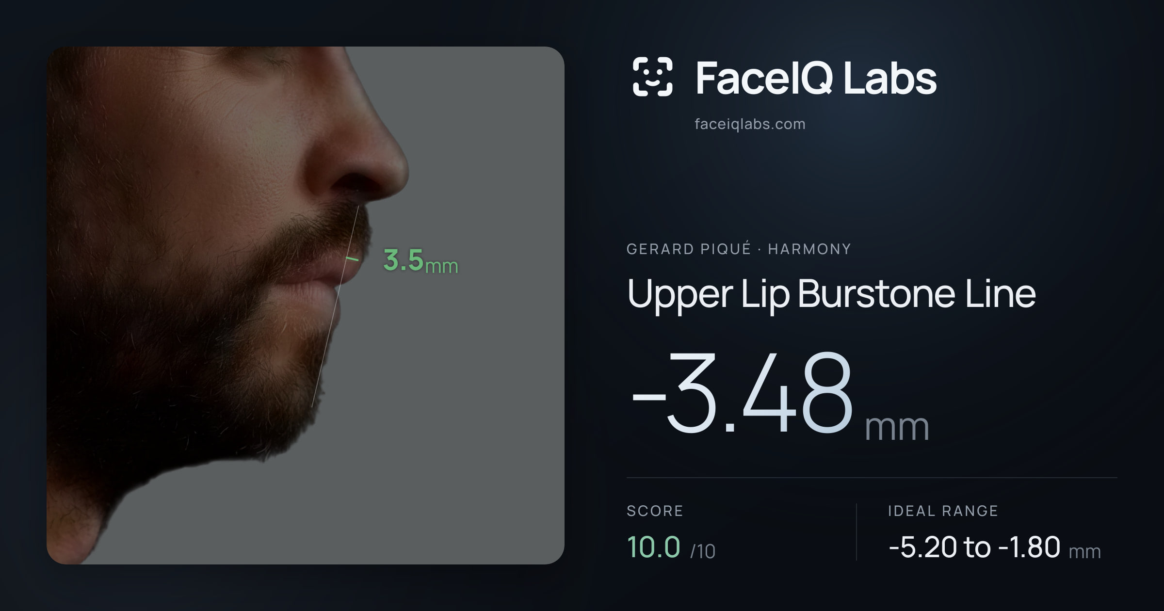 Gerard Piqué Upper Lip Burstone Line: -3.48mm, drawn on the photo