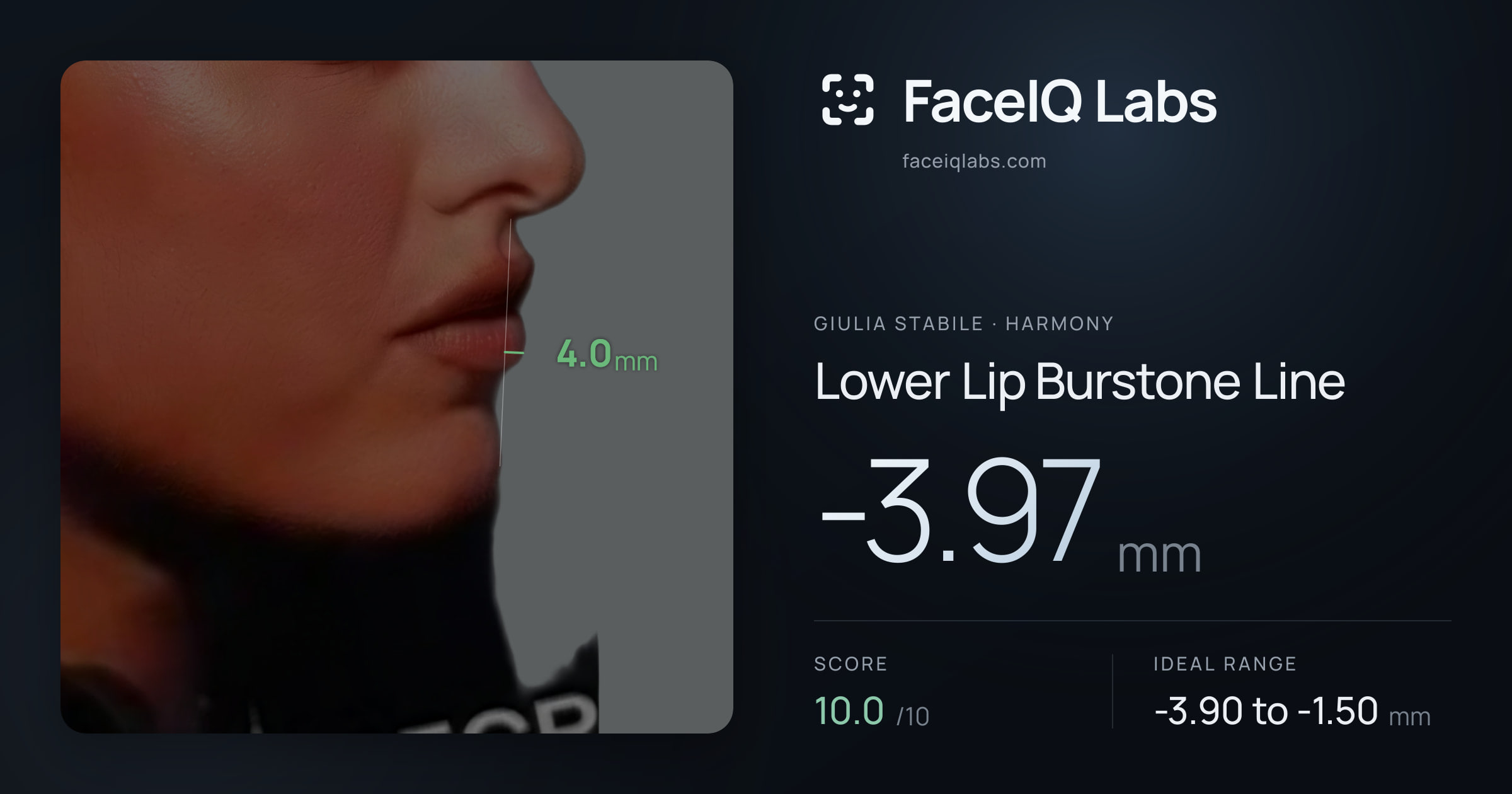 Giulia Stabile Lower Lip Burstone Line: -3.97mm, drawn on the photo