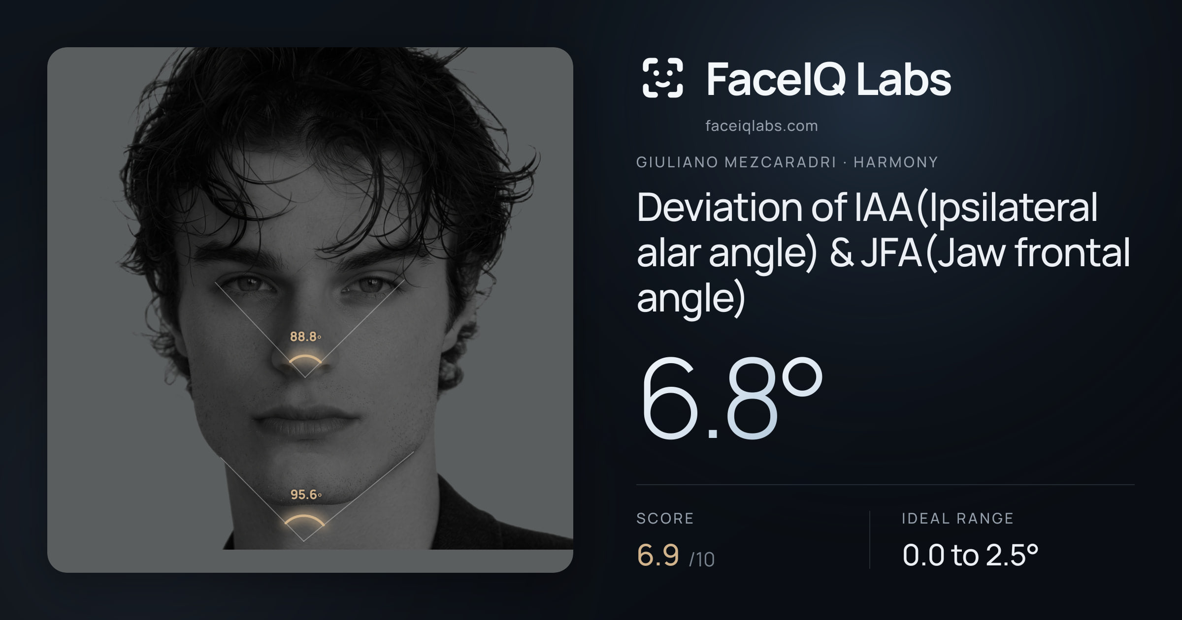 Giuliano Mezcaradri Deviation of IAA(Ipsilateral alar angle) & JFA(Jaw frontal angle): 1.4°, drawn on the photo