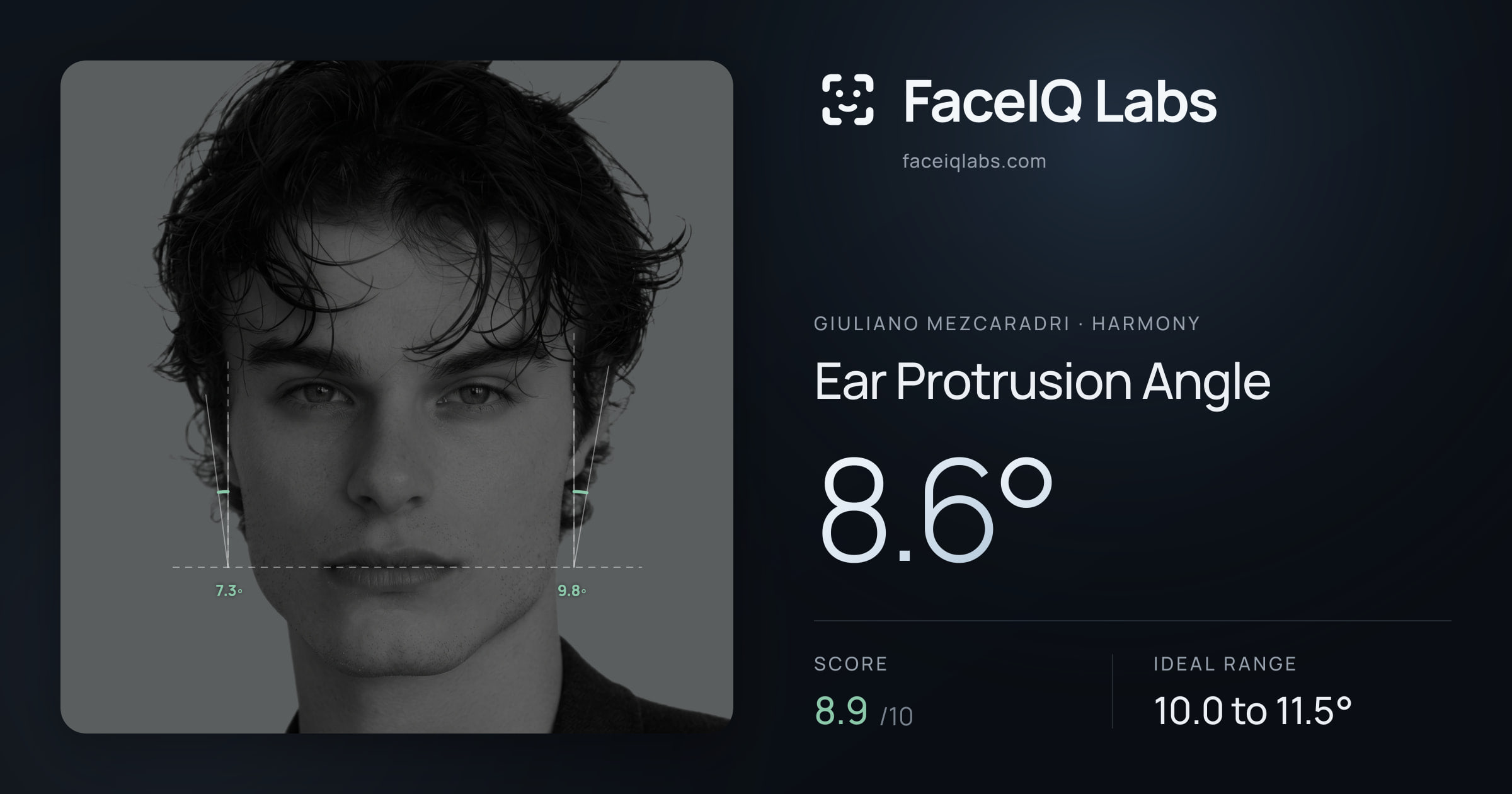 Giuliano Mezcaradri Ear Protrusion Angle: 9.3°, drawn on the photo