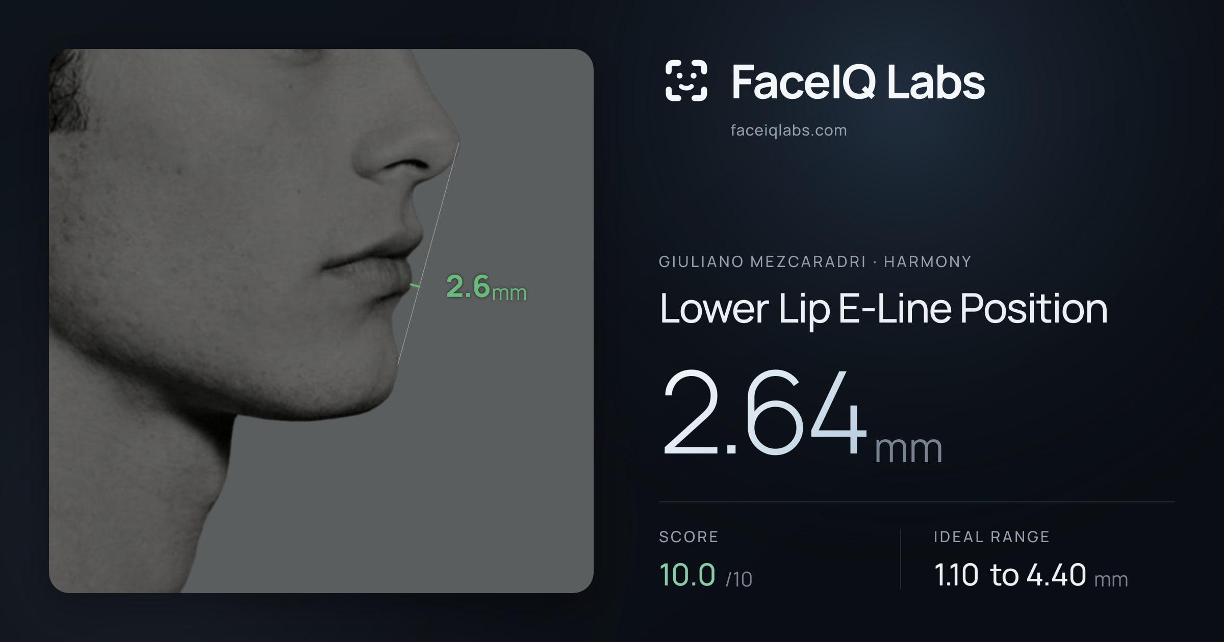 Giuliano Mezcaradri Lower Lip E-Line Position: 2.64mm, drawn on the photo