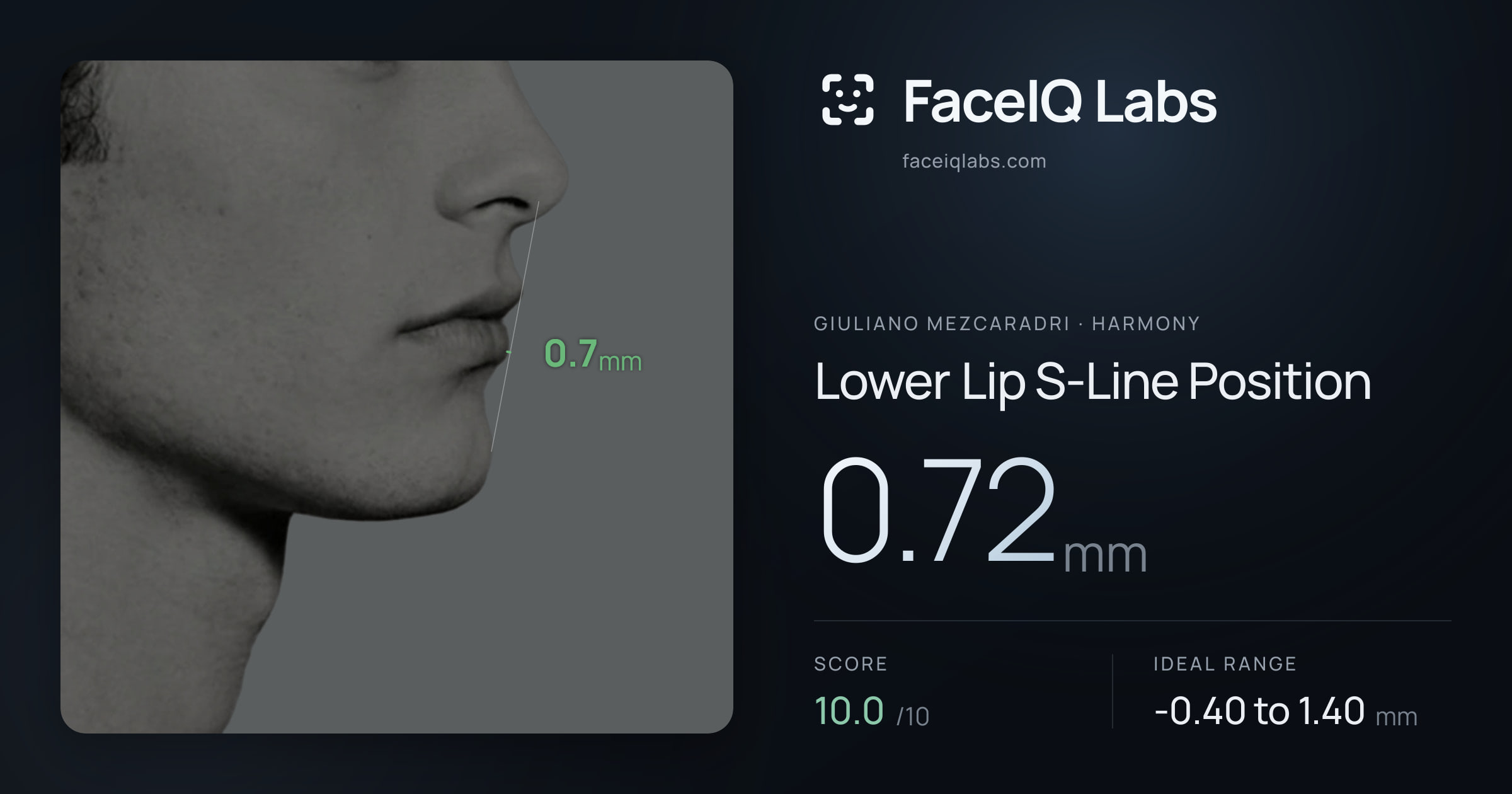 Giuliano Mezcaradri Lower Lip S-Line Position: 0.72mm, drawn on the photo
