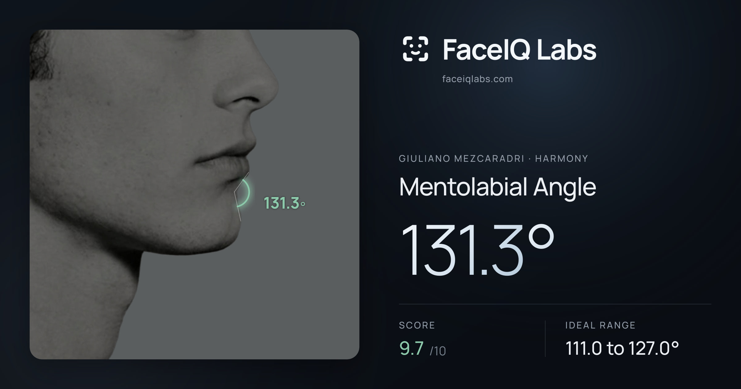 Giuliano Mezcaradri Mentolabial Angle: 131.3°, drawn on the photo
