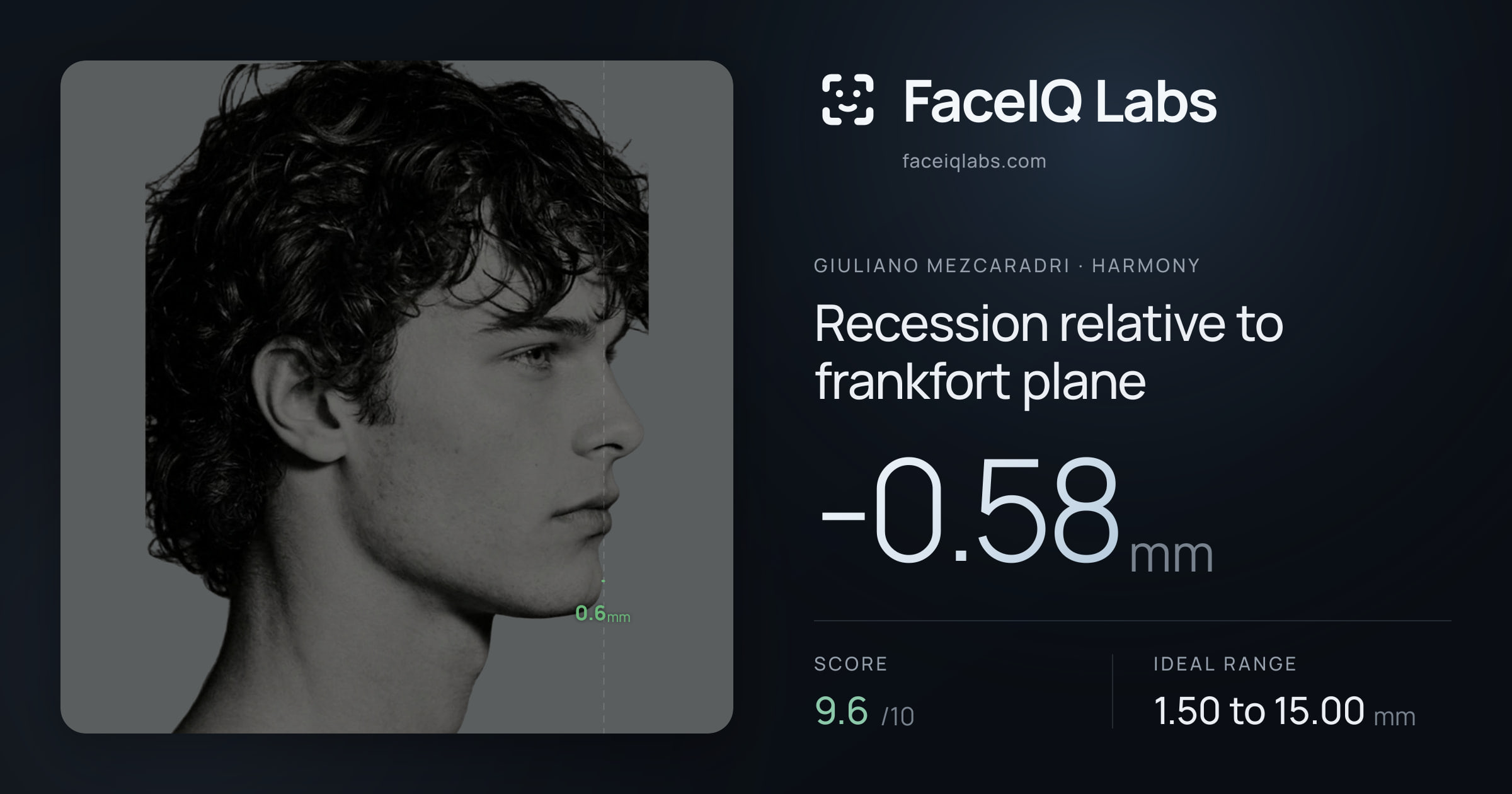 Giuliano Mezcaradri Recession relative to frankfort plane: -0.58mm, drawn on the photo