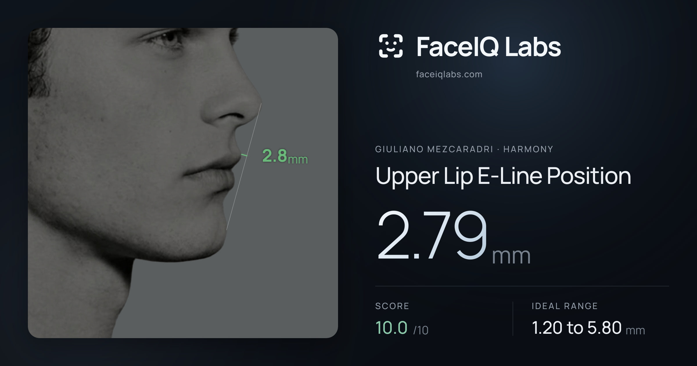 Giuliano Mezcaradri Upper Lip E-Line Position: 2.79mm, drawn on the photo
