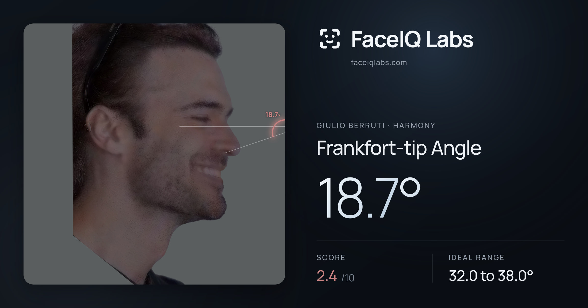 Giulio Berruti Frankfort-tip Angle: 18.7°, drawn on the photo