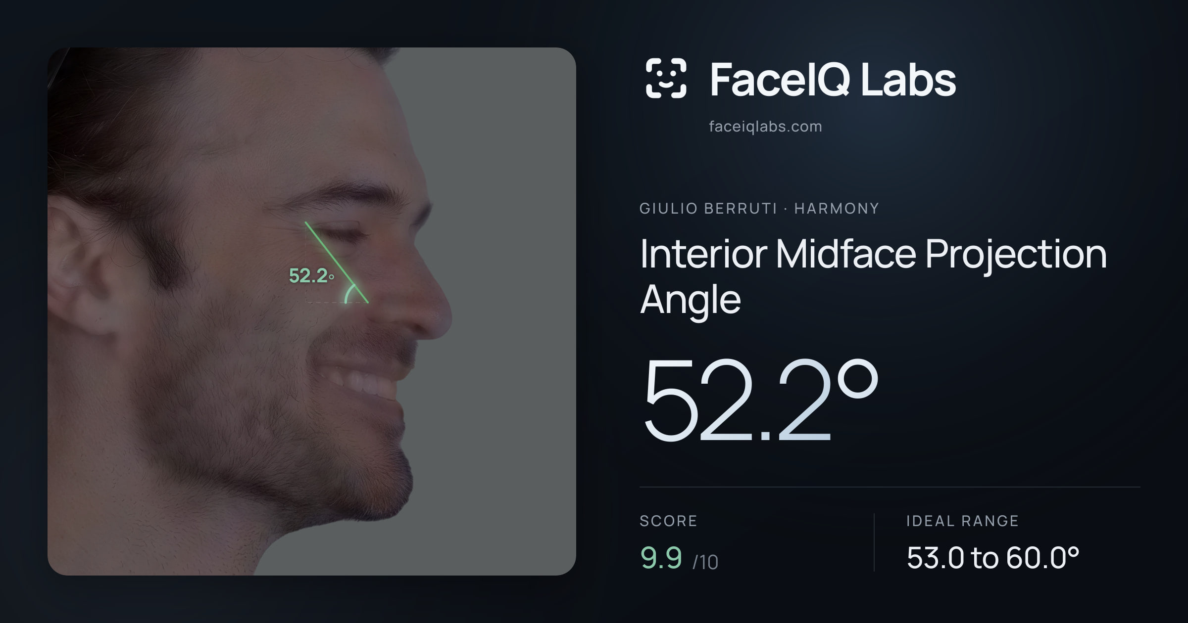 Giulio Berruti Interior Midface Projection Angle: 52.2°, drawn on the photo
