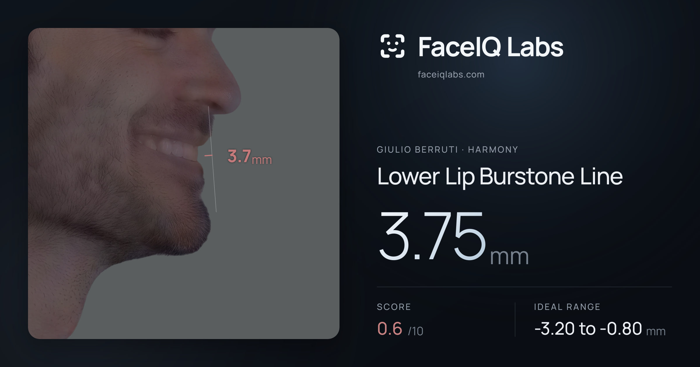 Giulio Berruti Lower Lip Burstone Line: 3.75mm, drawn on the photo