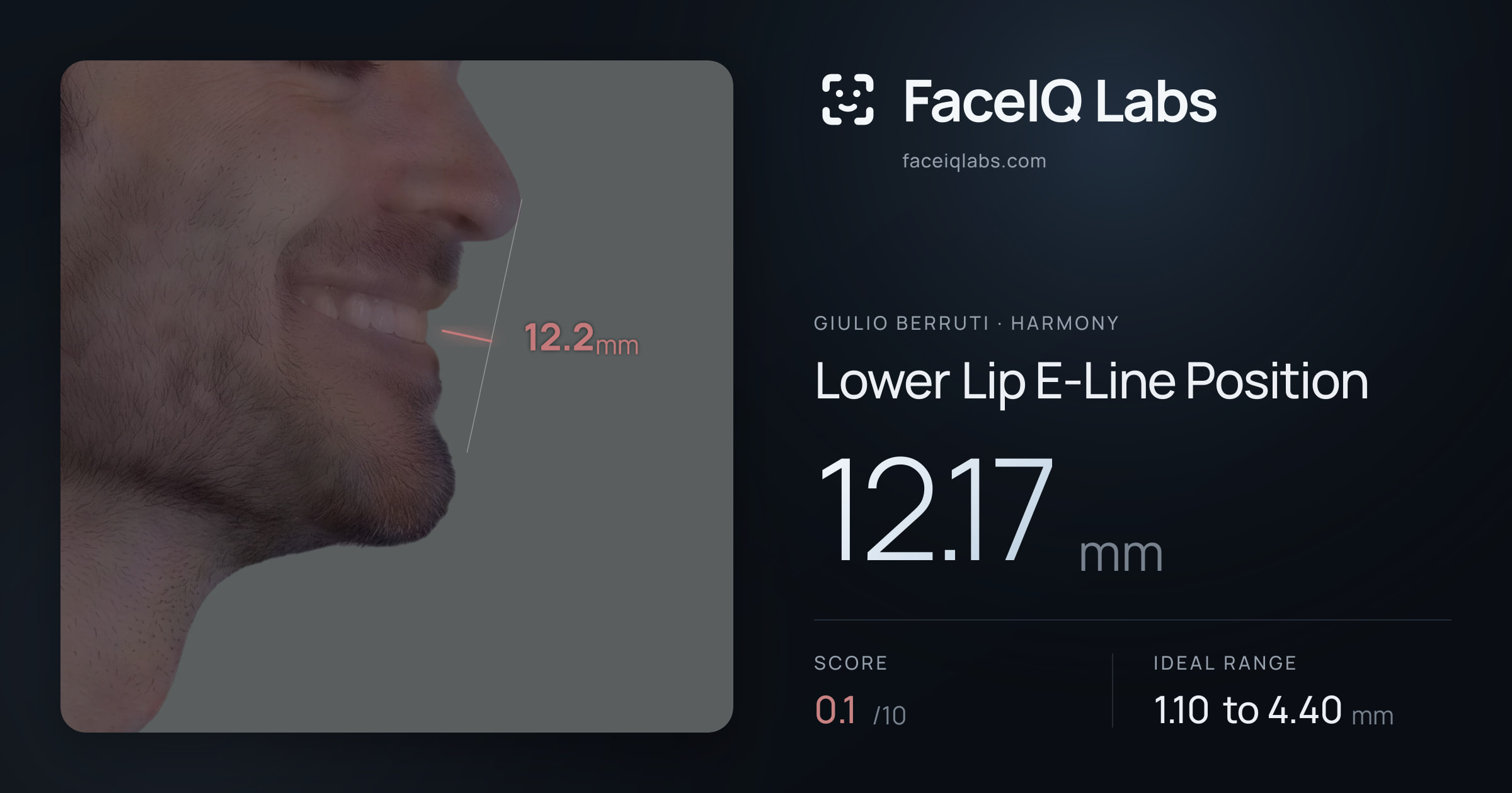 Giulio Berruti Lower Lip E-Line Position: 12.17mm, drawn on the photo