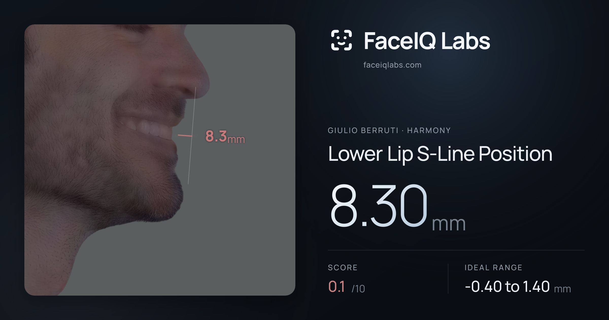 Giulio Berruti Lower Lip S-Line Position: 8.30mm, drawn on the photo