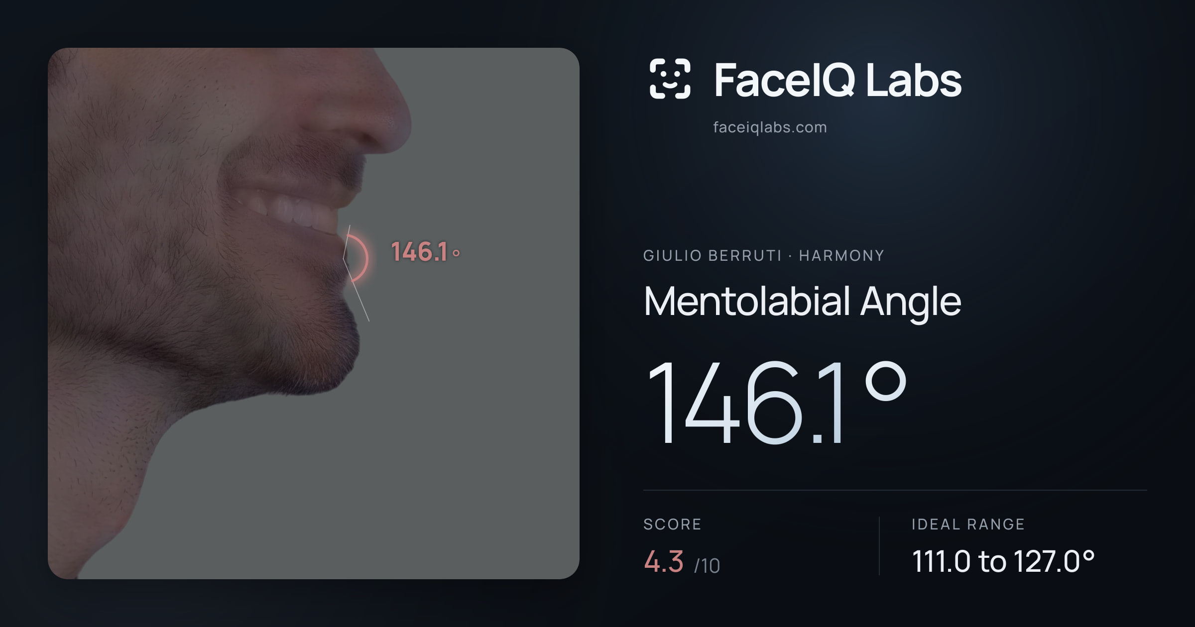 Giulio Berruti Mentolabial Angle: 146.1°, drawn on the photo