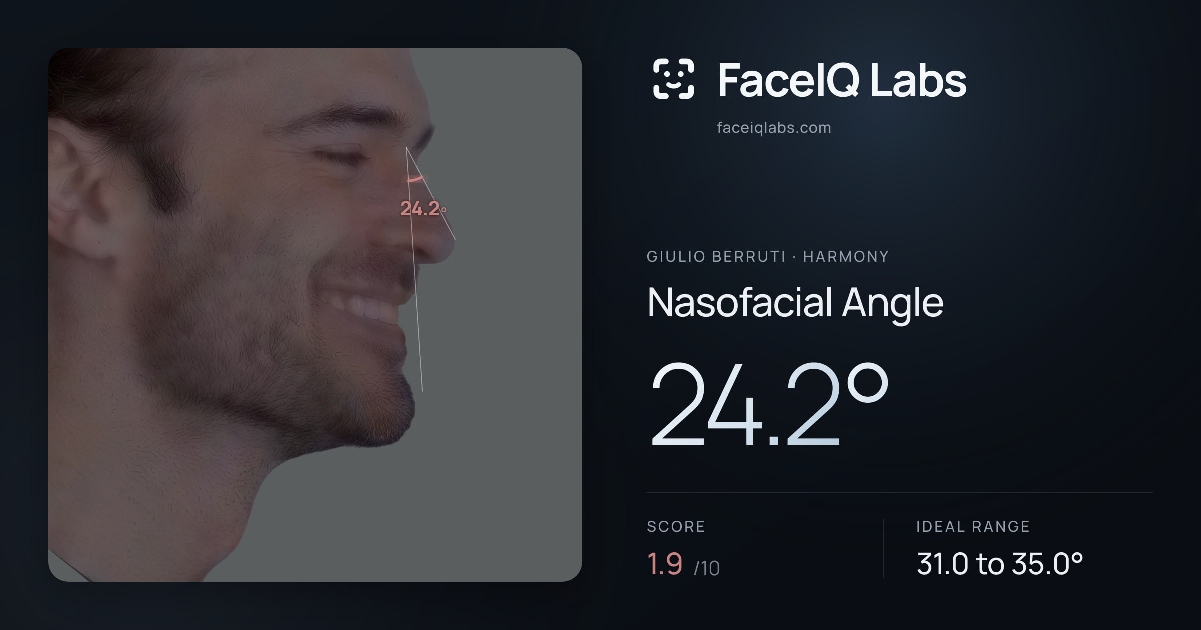 Giulio Berruti Nasofacial Angle: 24.2°, drawn on the photo