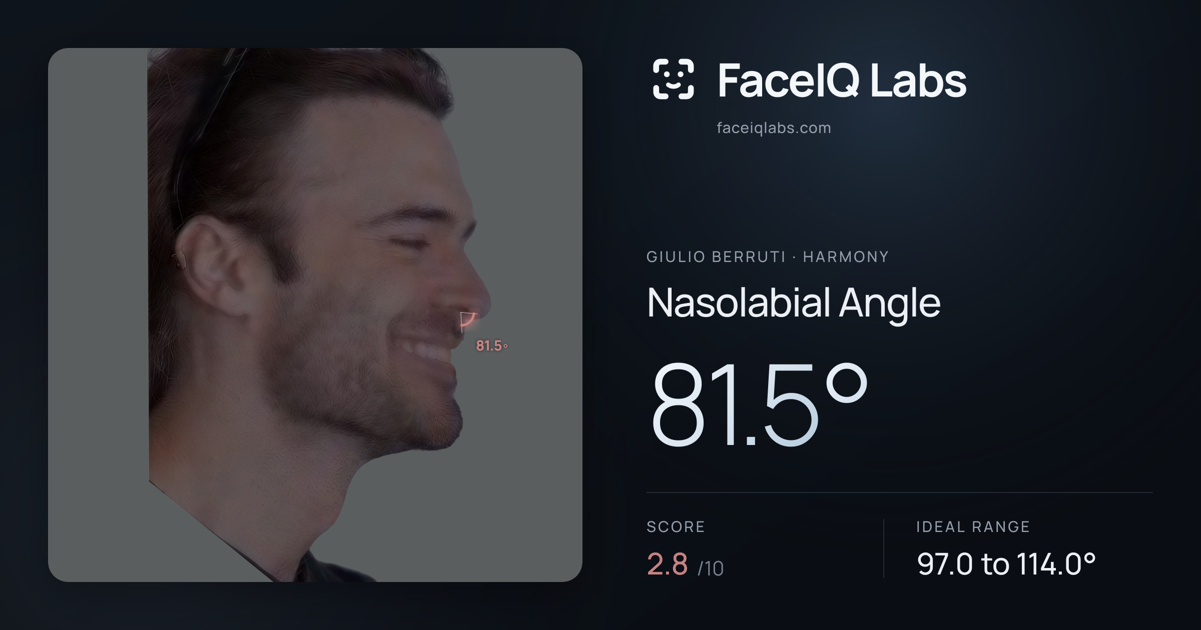 Giulio Berruti Nasolabial Angle: 81.5°, drawn on the photo