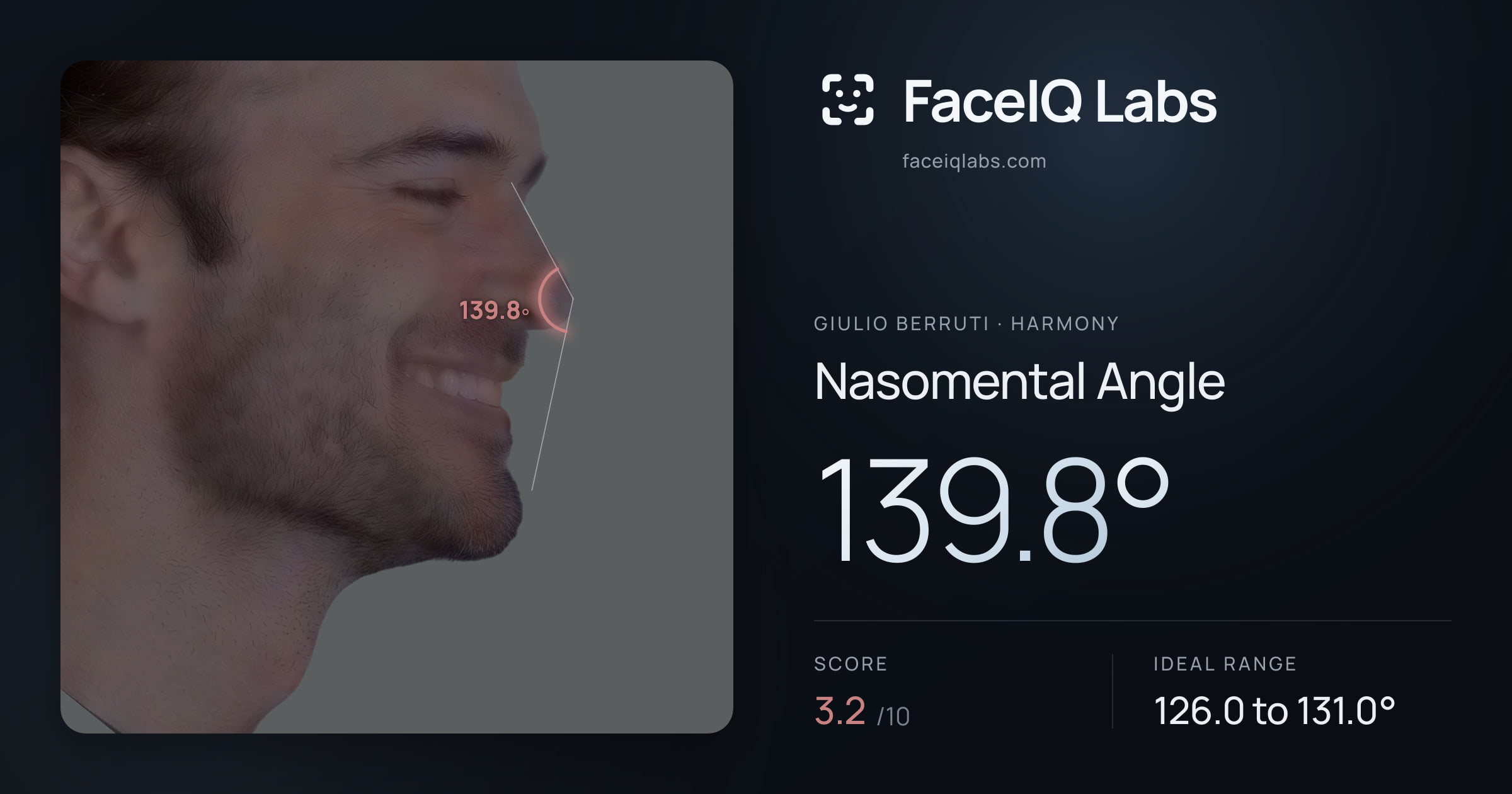 Giulio Berruti Nasomental Angle: 139.8°, drawn on the photo