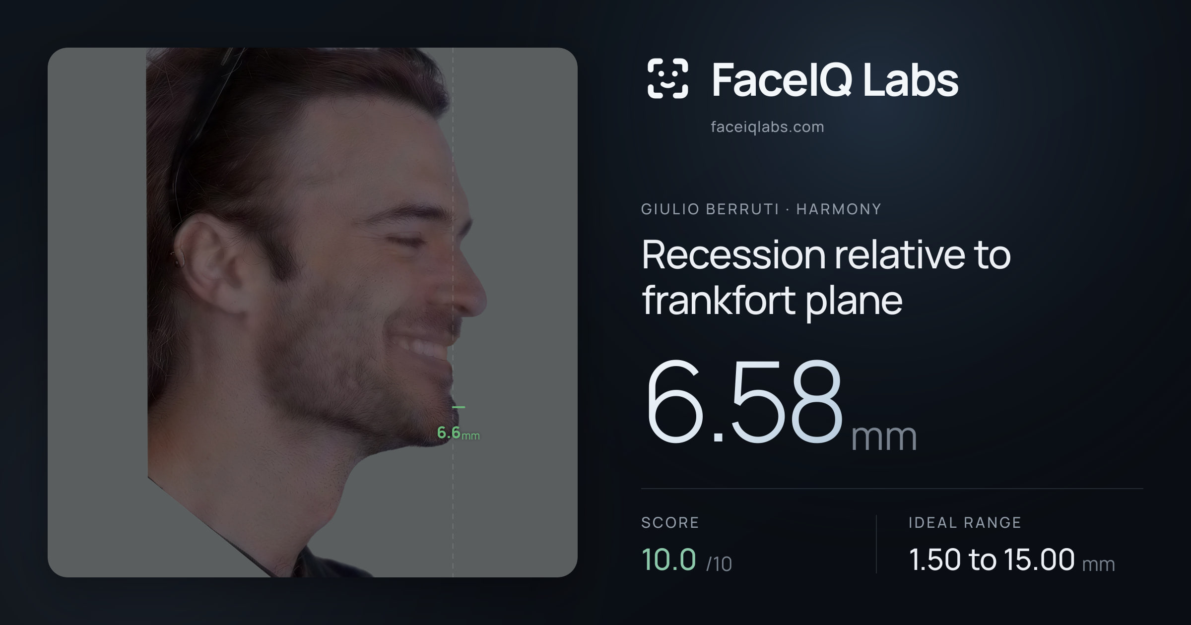 Giulio Berruti Recession relative to frankfort plane: 6.58mm, drawn on the photo