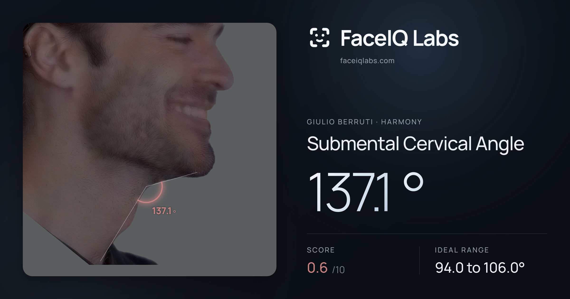 Giulio Berruti Submental Cervical Angle: 137.1°, drawn on the photo