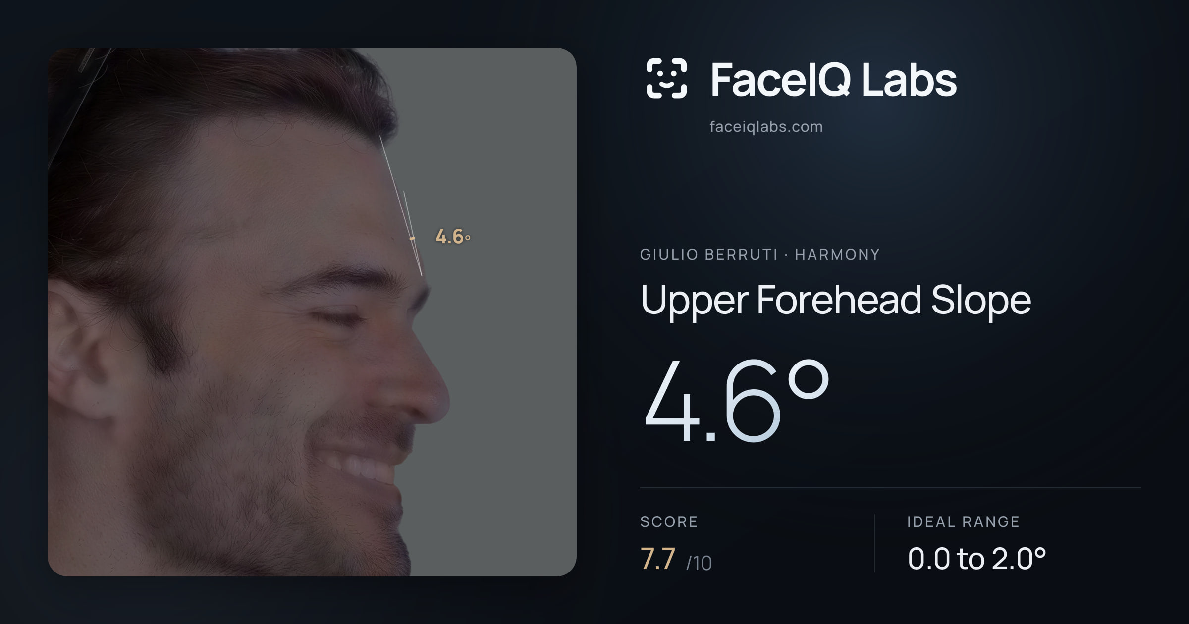 Giulio Berruti Upper Forehead Slope: 4.6°, drawn on the photo