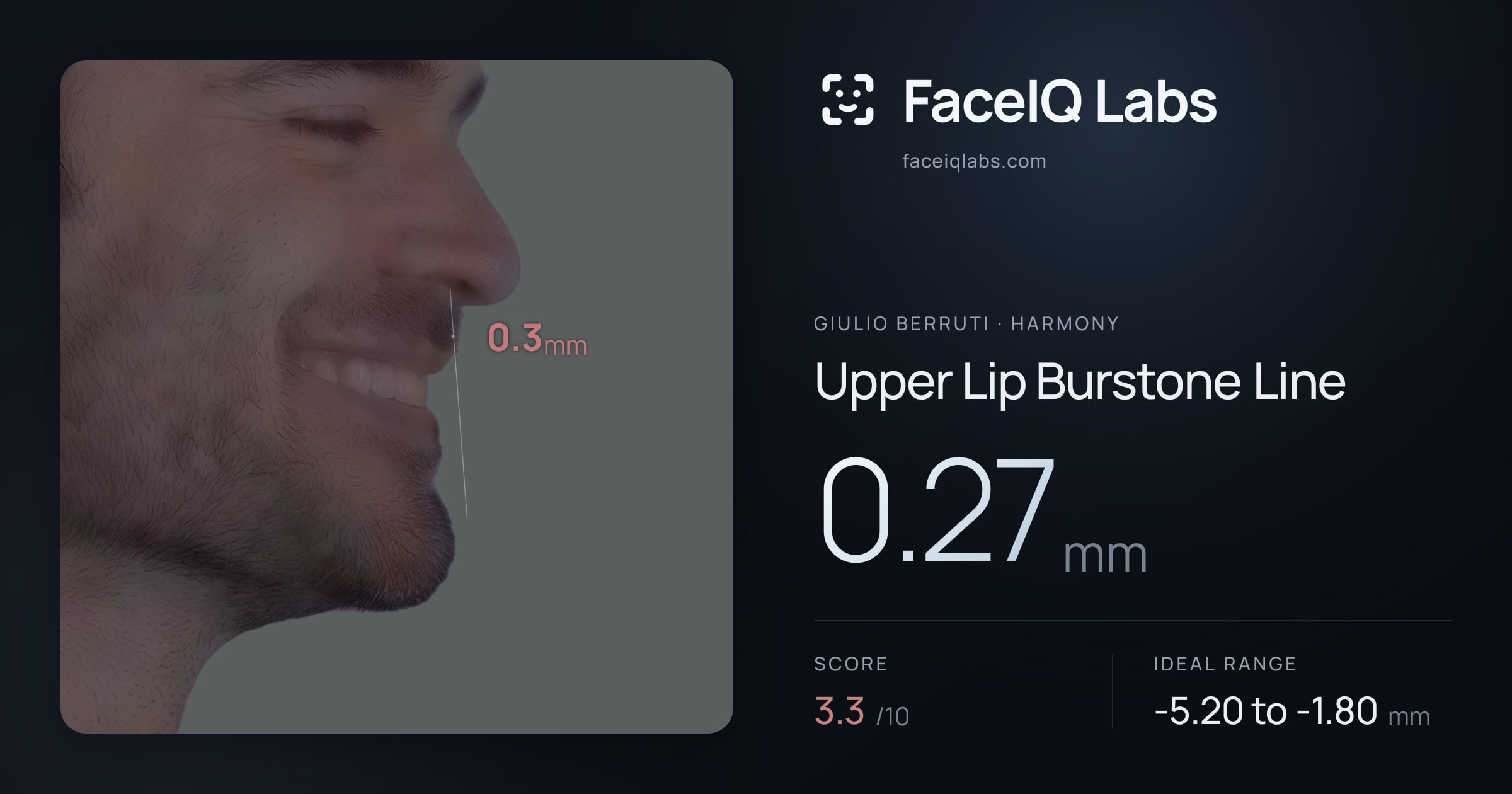 Giulio Berruti Upper Lip Burstone Line: 0.27mm, drawn on the photo