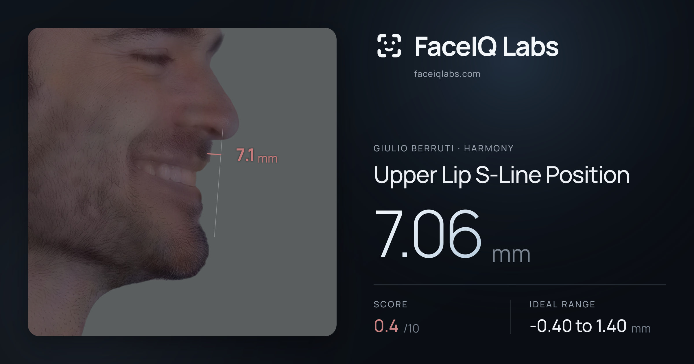 Giulio Berruti Upper Lip S-Line Position: 7.06mm, drawn on the photo