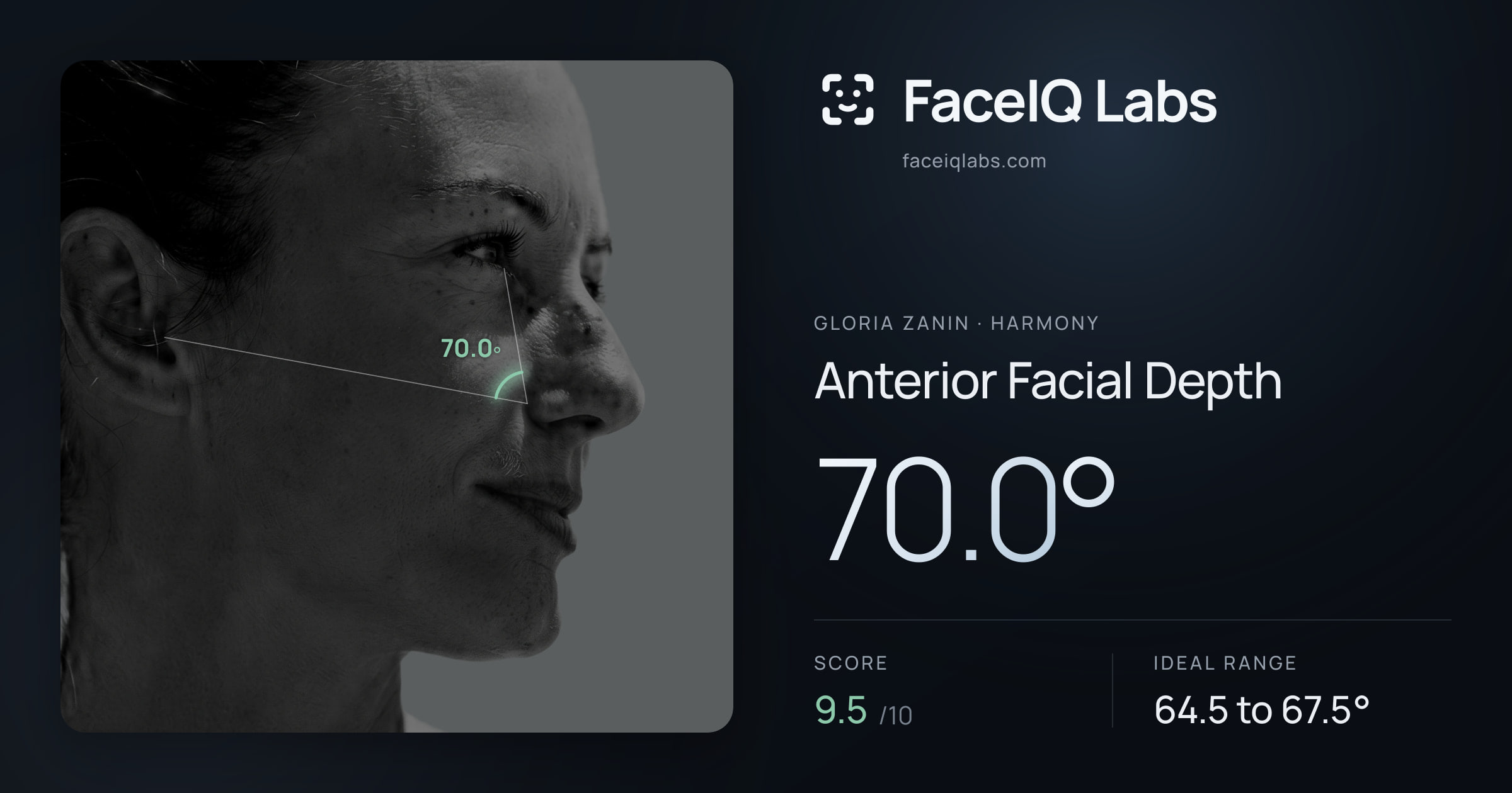 Gloria Zanin Anterior Facial Depth: 70.0°, drawn on the photo