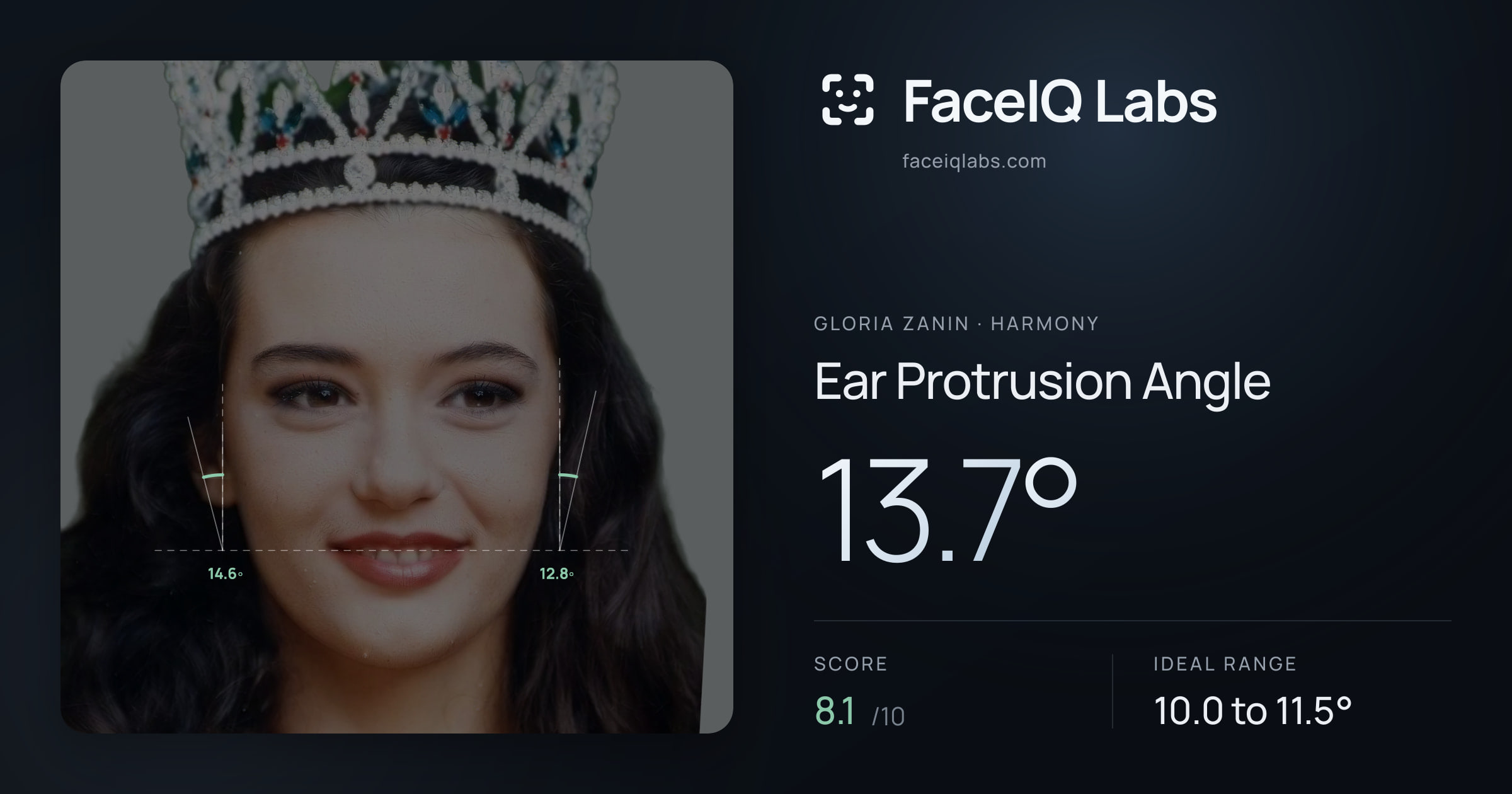 Gloria Zanin Ear Protrusion Angle: 13.7°, drawn on the photo