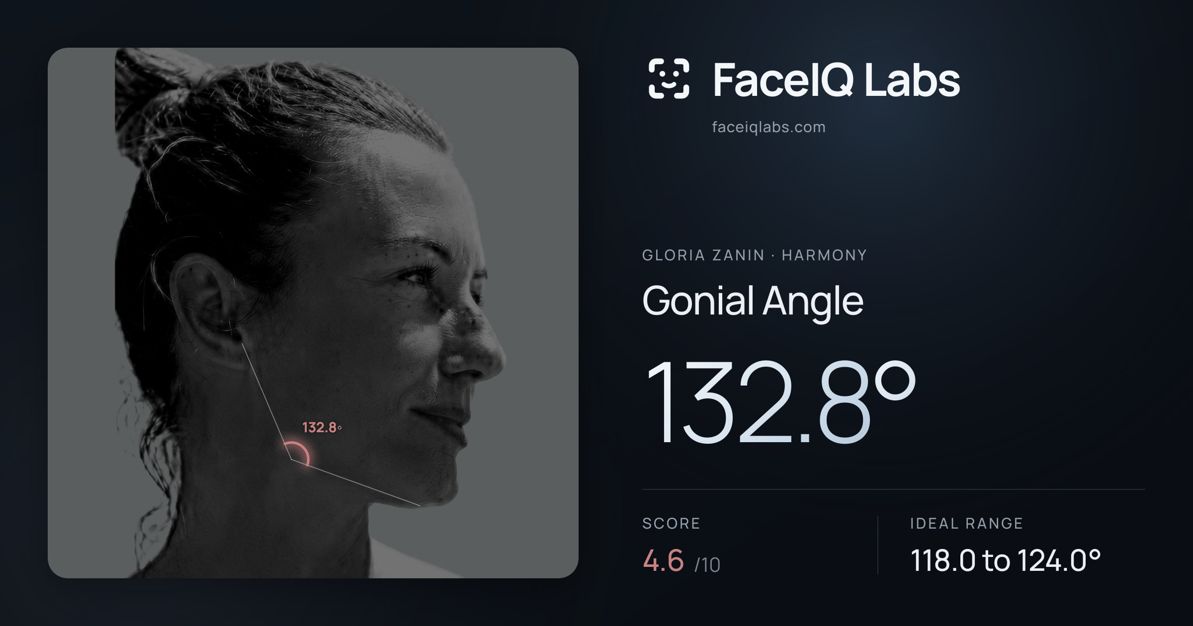 Gloria Zanin Gonial Angle: 132.8°, drawn on the photo