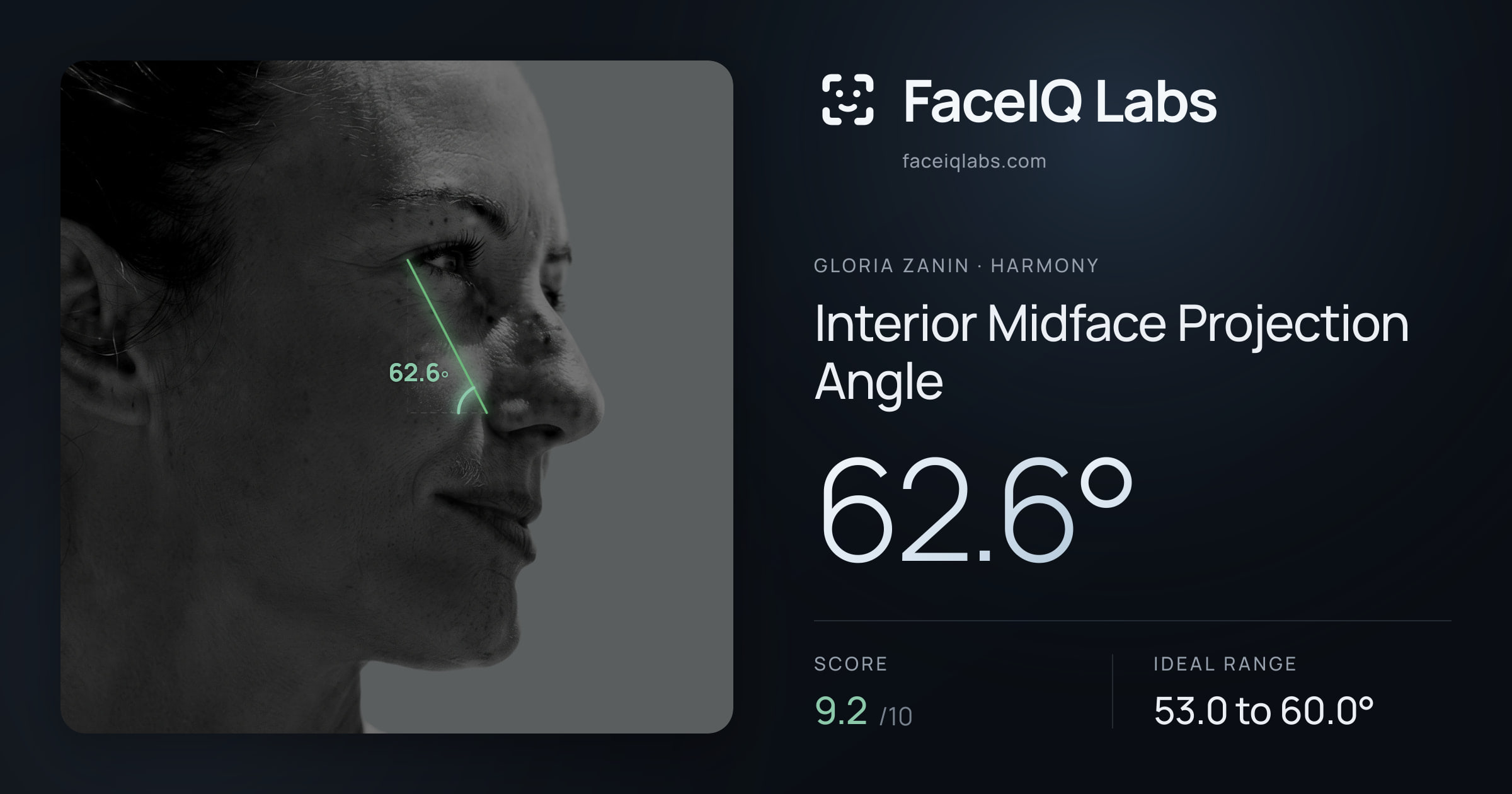 Gloria Zanin Interior Midface Projection Angle: 62.6°, drawn on the photo