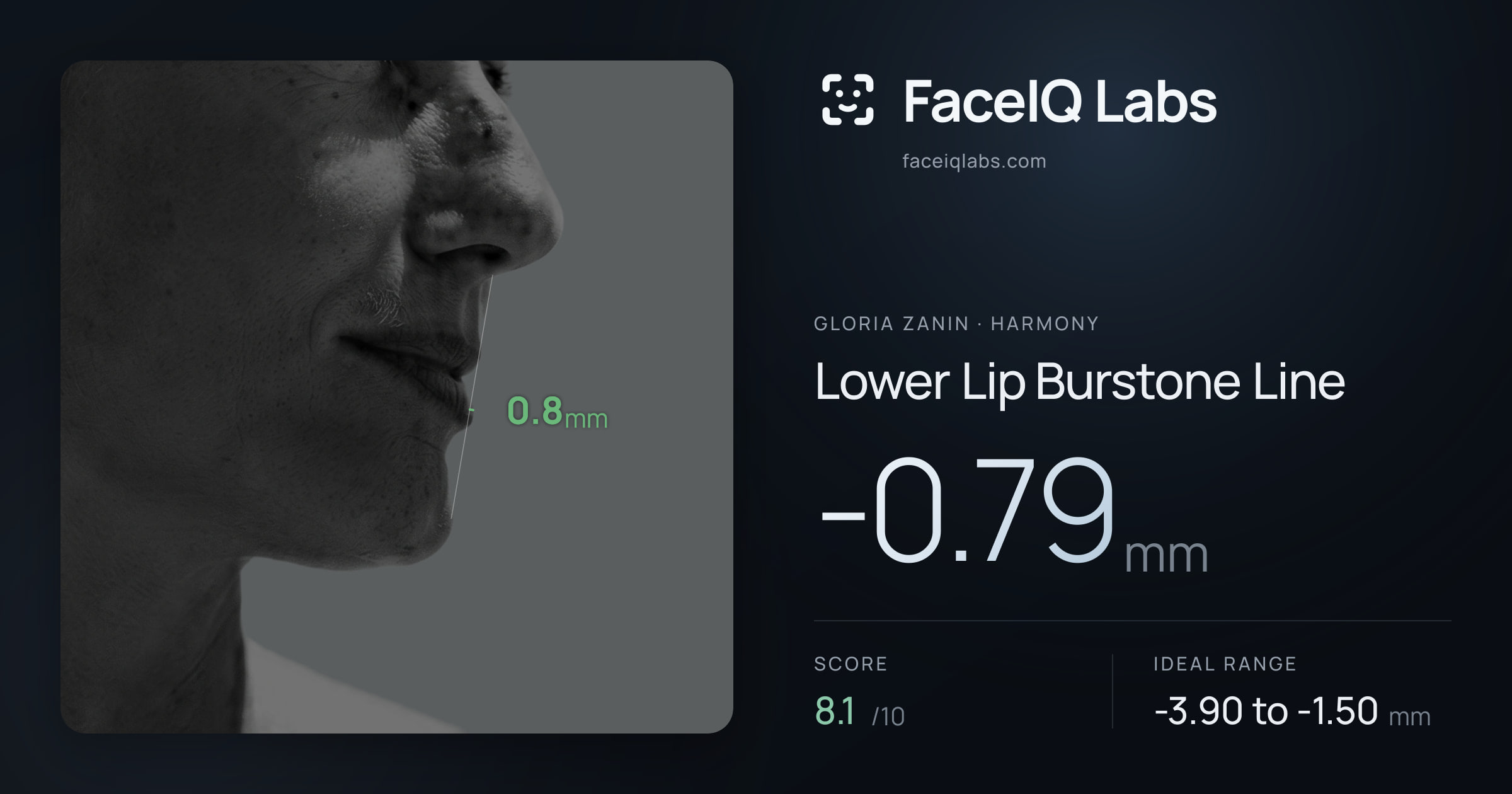 Gloria Zanin Lower Lip Burstone Line: -0.79mm, drawn on the photo