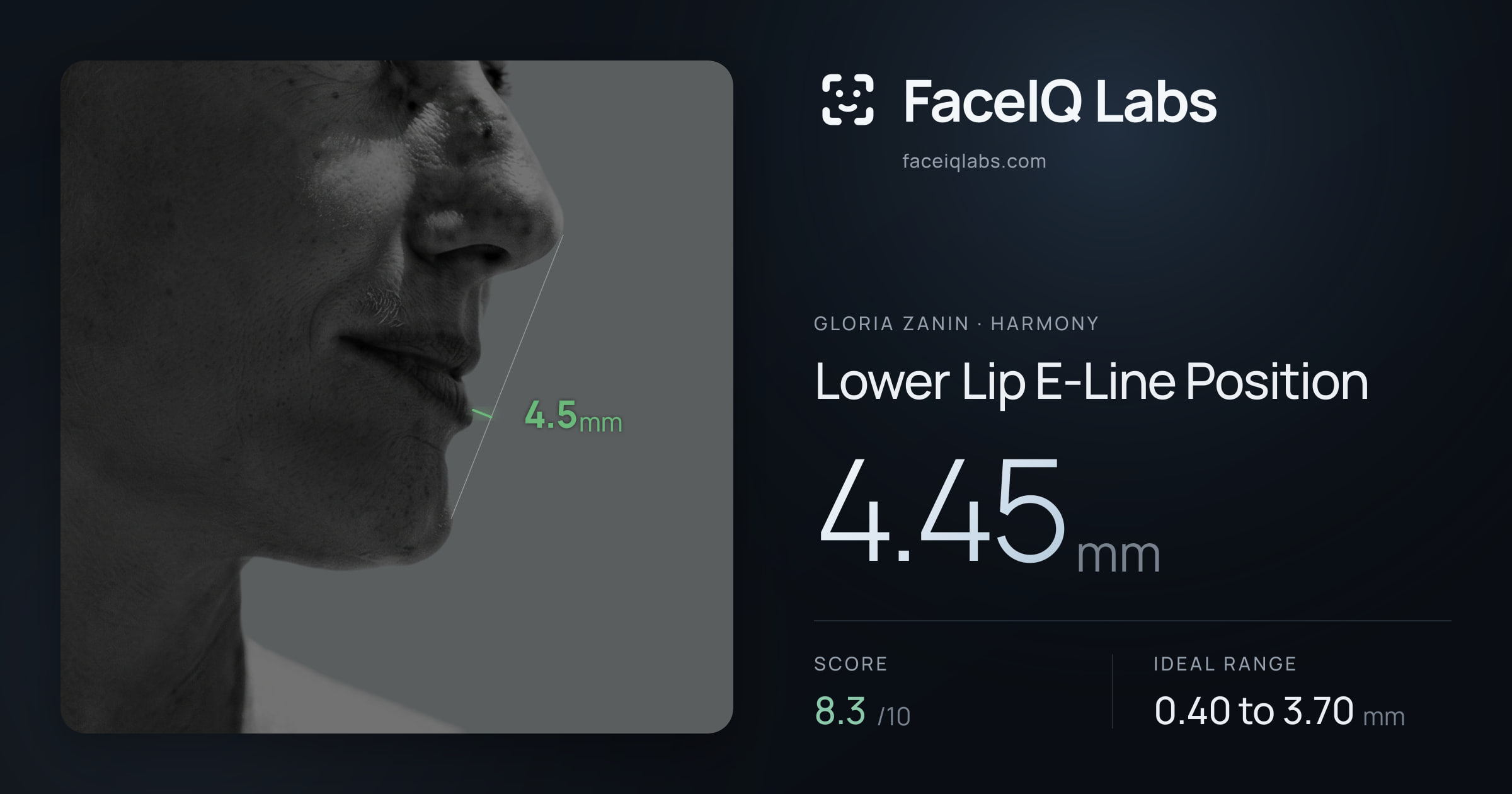 Gloria Zanin Lower Lip E-Line Position: 4.45mm, drawn on the photo