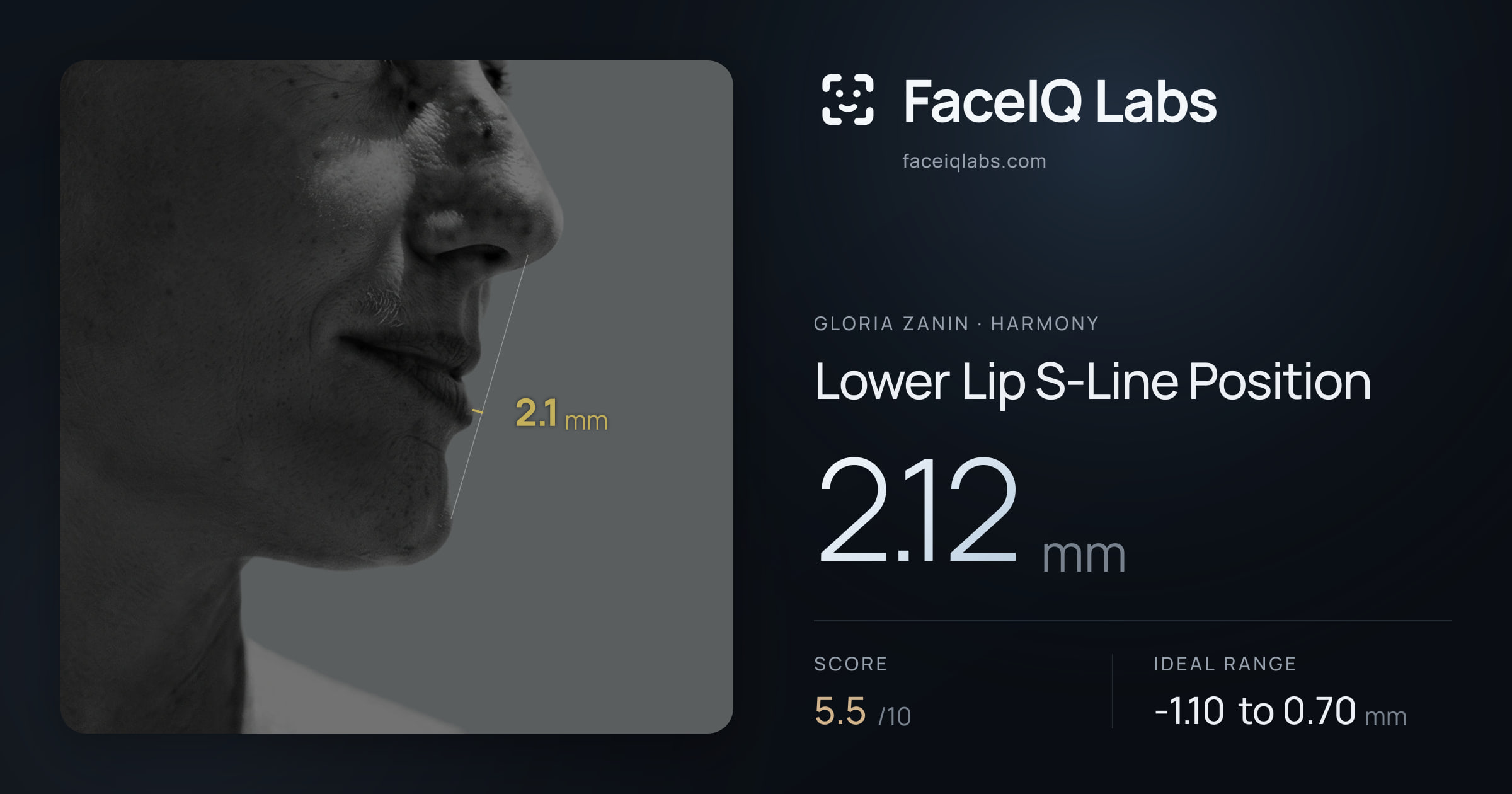 Gloria Zanin Lower Lip S-Line Position: 2.12mm, drawn on the photo