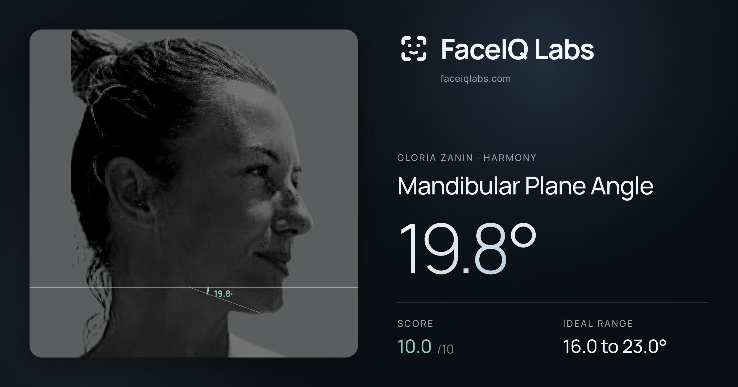 Gloria Zanin Mandibular Plane Angle: 19.8°, drawn on the photo