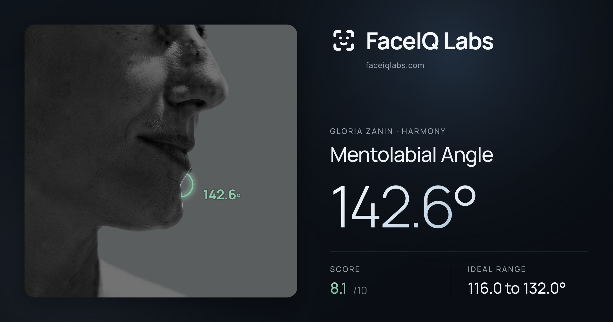 Gloria Zanin Mentolabial Angle: 142.6°, drawn on the photo