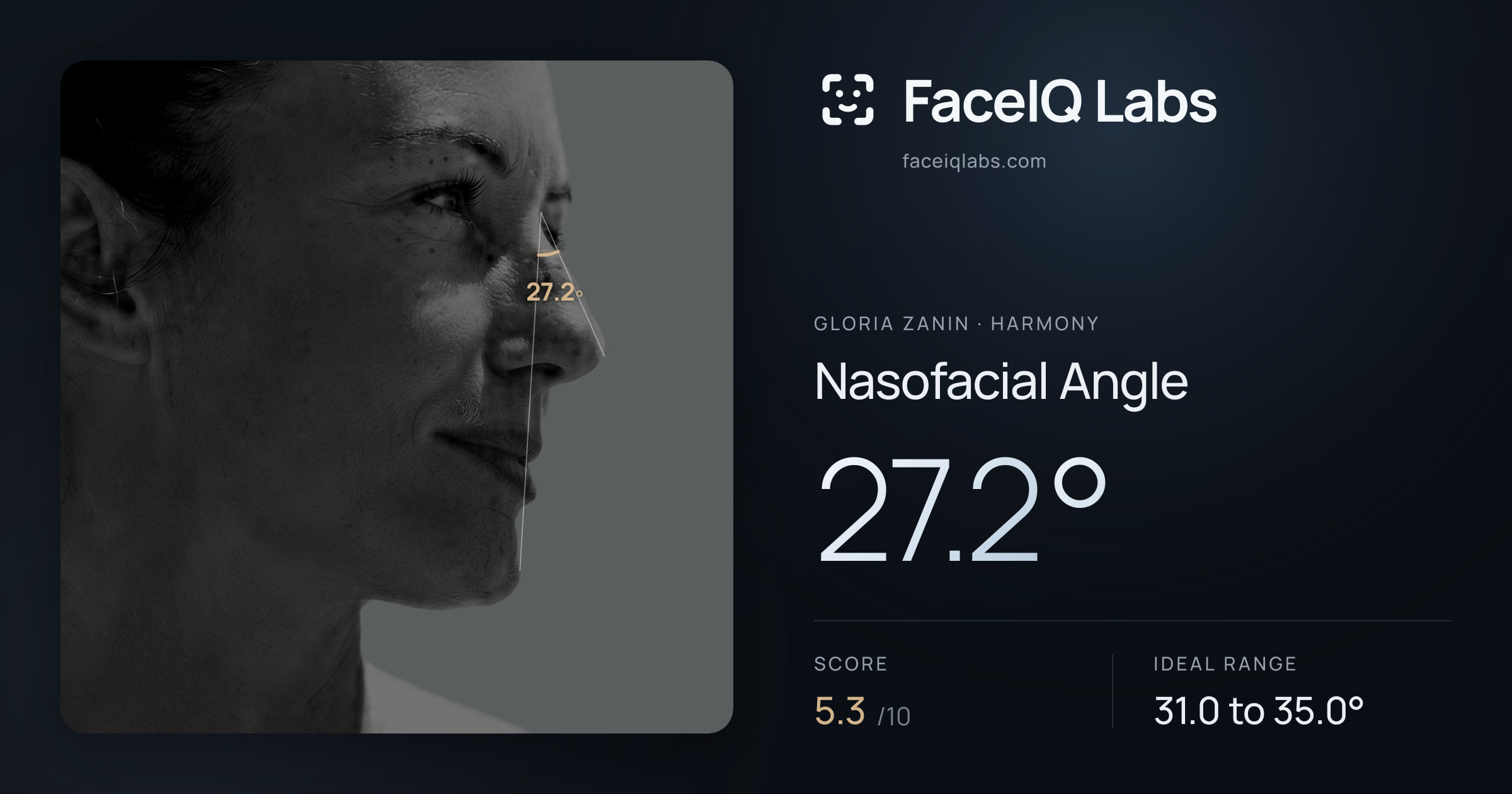 Gloria Zanin Nasofacial Angle: 27.2°, drawn on the photo