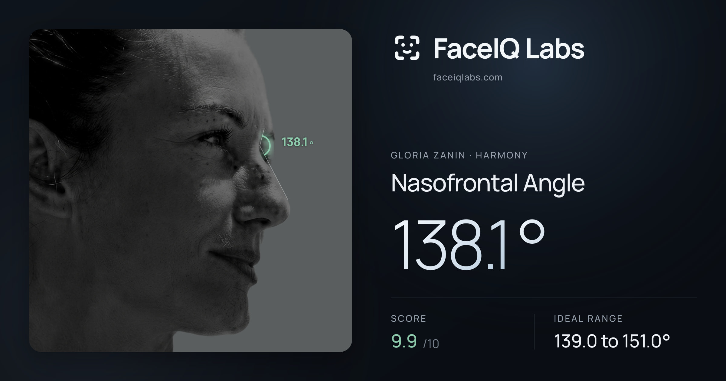 Gloria Zanin Nasofrontal Angle: 138.1°, drawn on the photo