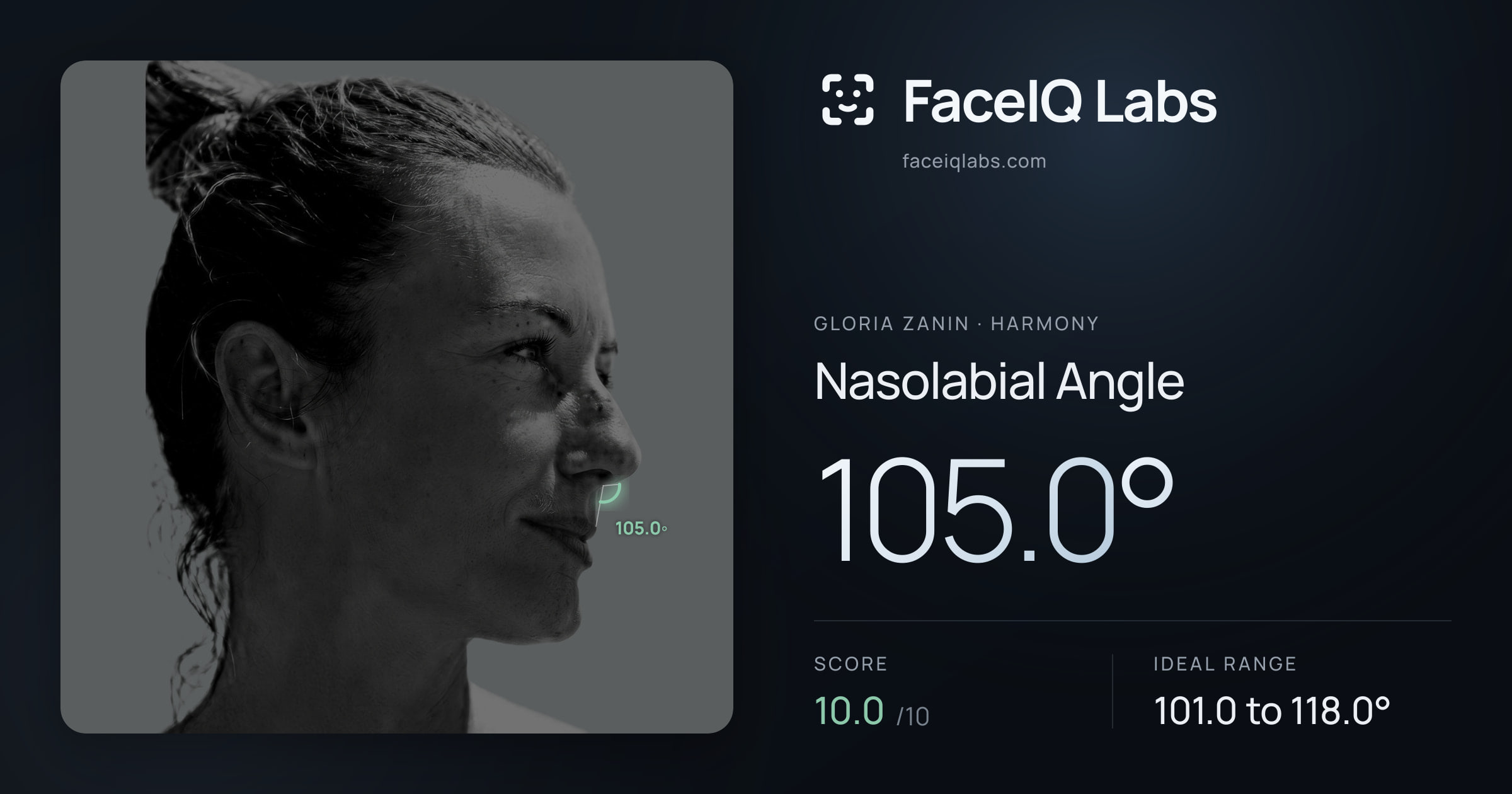 Gloria Zanin Nasolabial Angle: 105.0°, drawn on the photo
