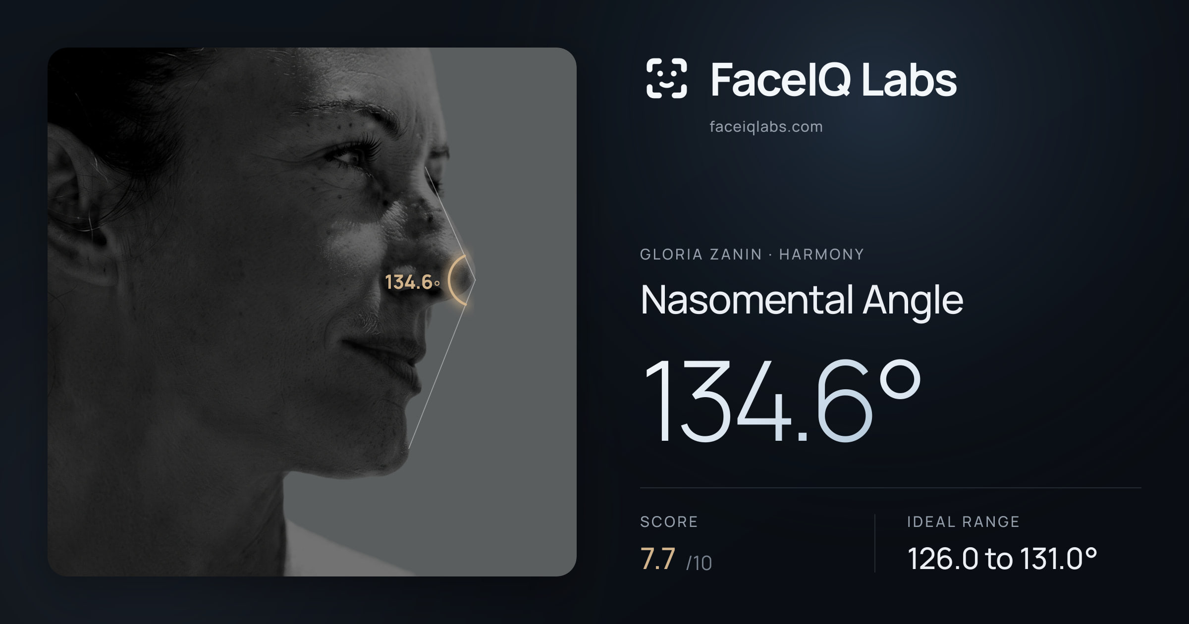Gloria Zanin Nasomental Angle: 134.6°, drawn on the photo