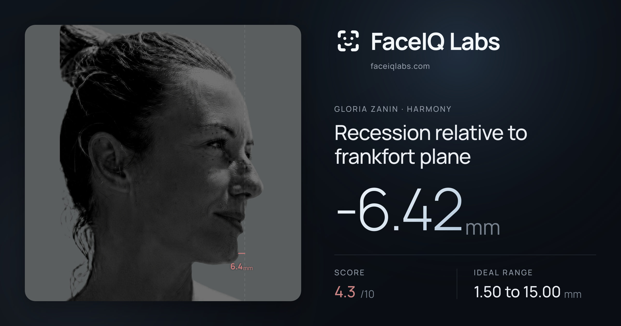 Gloria Zanin Recession relative to frankfort plane: -6.42mm, drawn on the photo