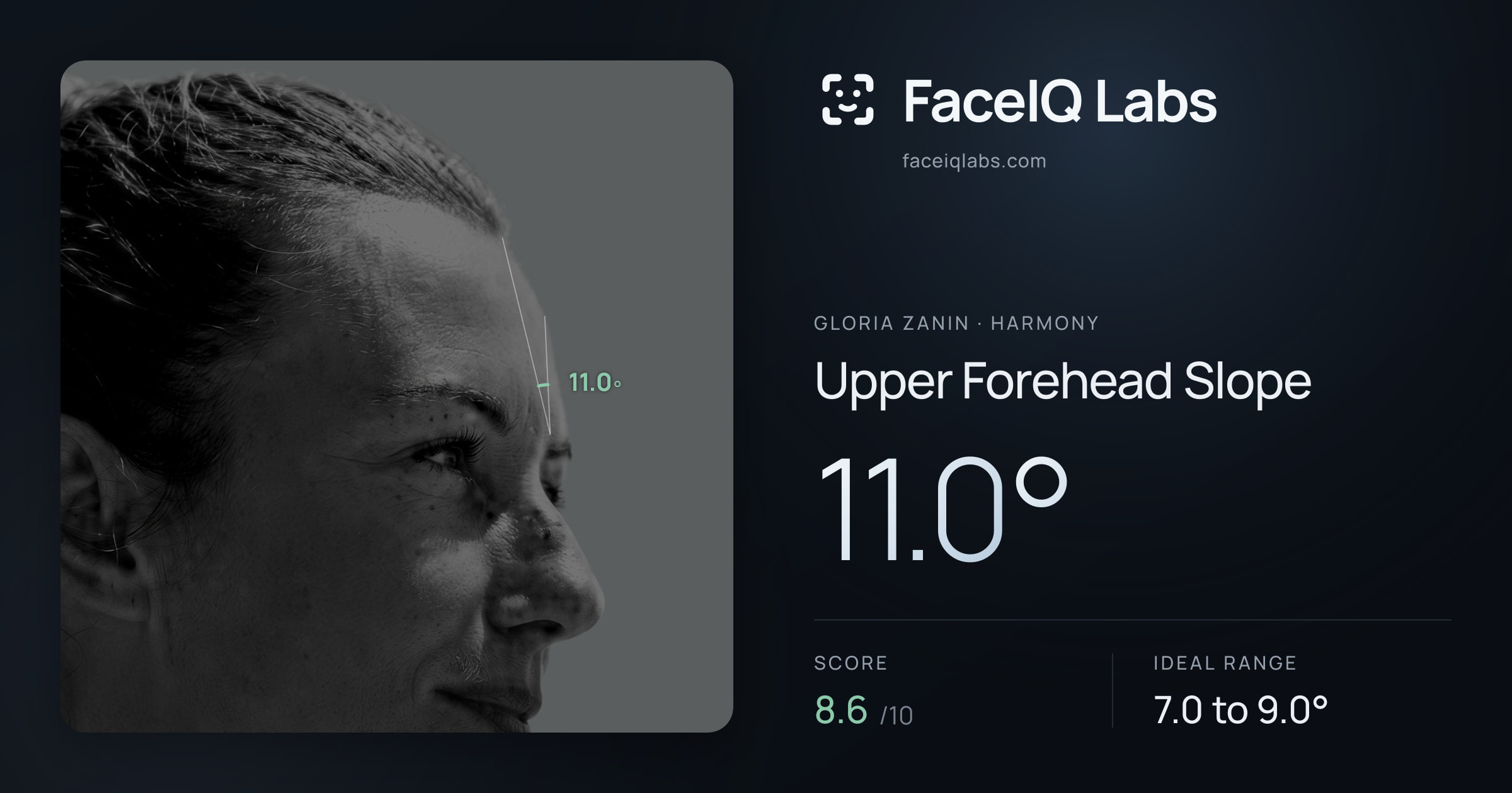 Gloria Zanin Upper Forehead Slope: 11.0°, drawn on the photo