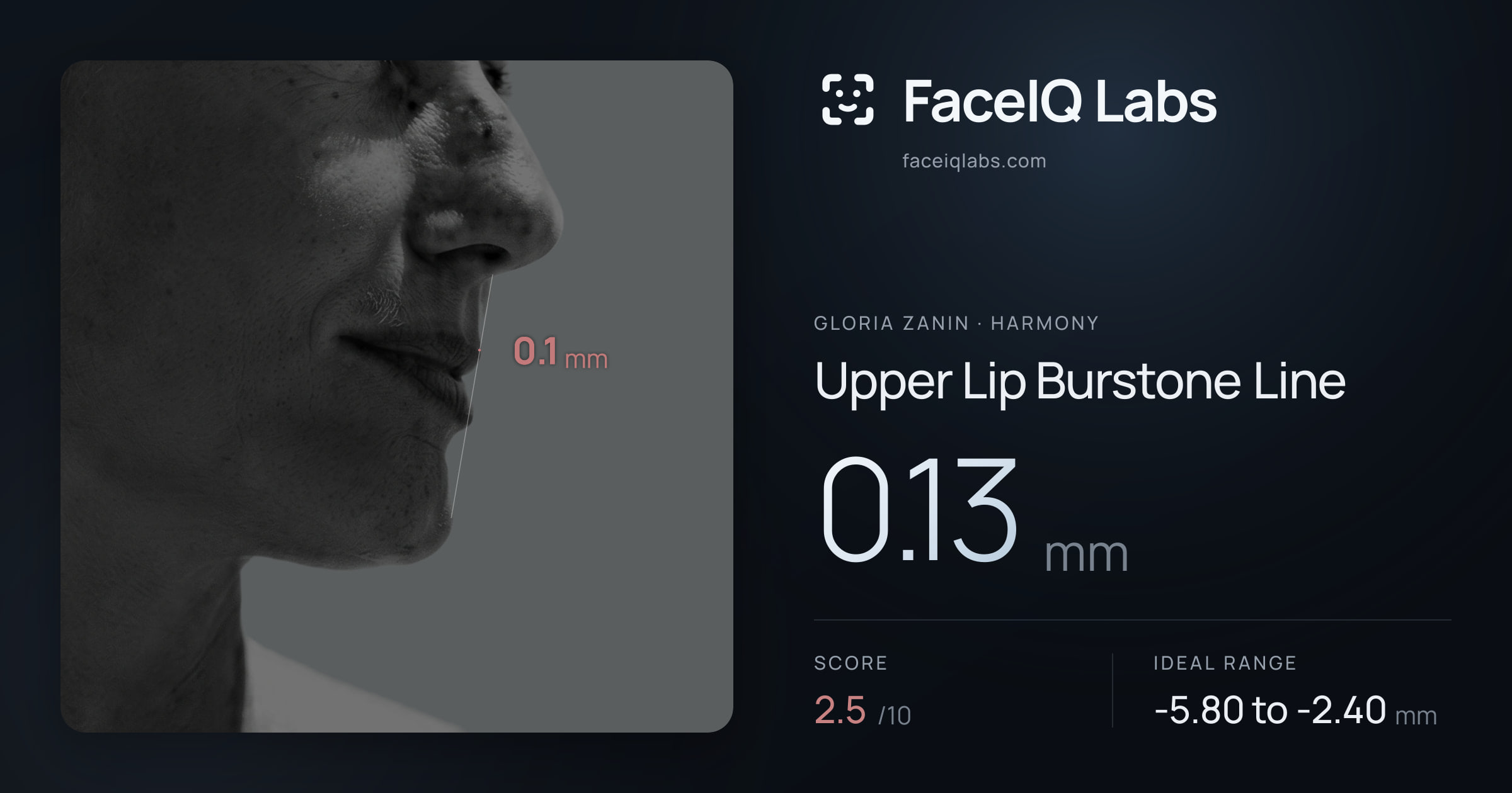 Gloria Zanin Upper Lip Burstone Line: 0.13mm, drawn on the photo