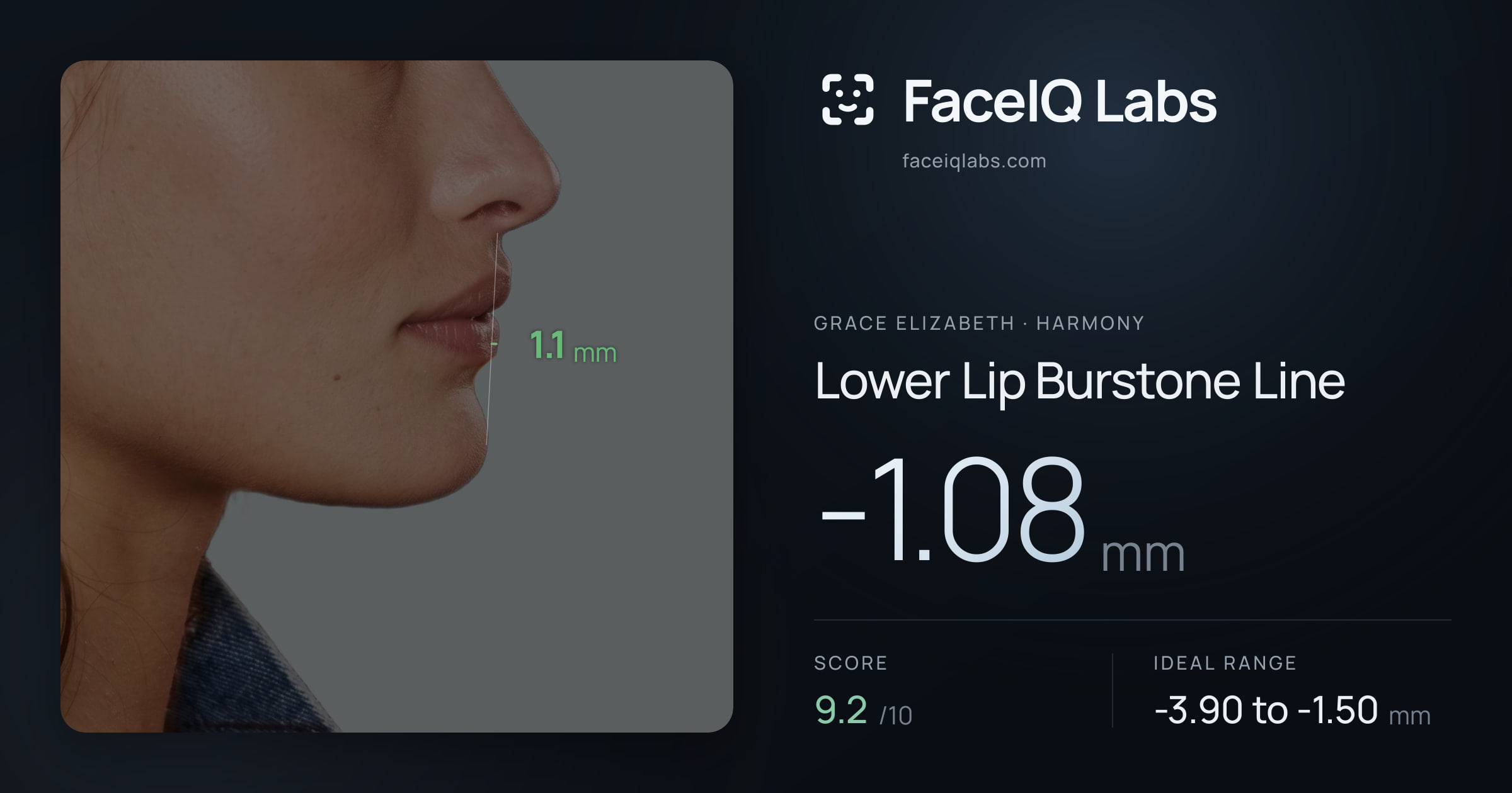 Grace Elizabeth Lower Lip Burstone Line: -1.08mm, drawn on the photo