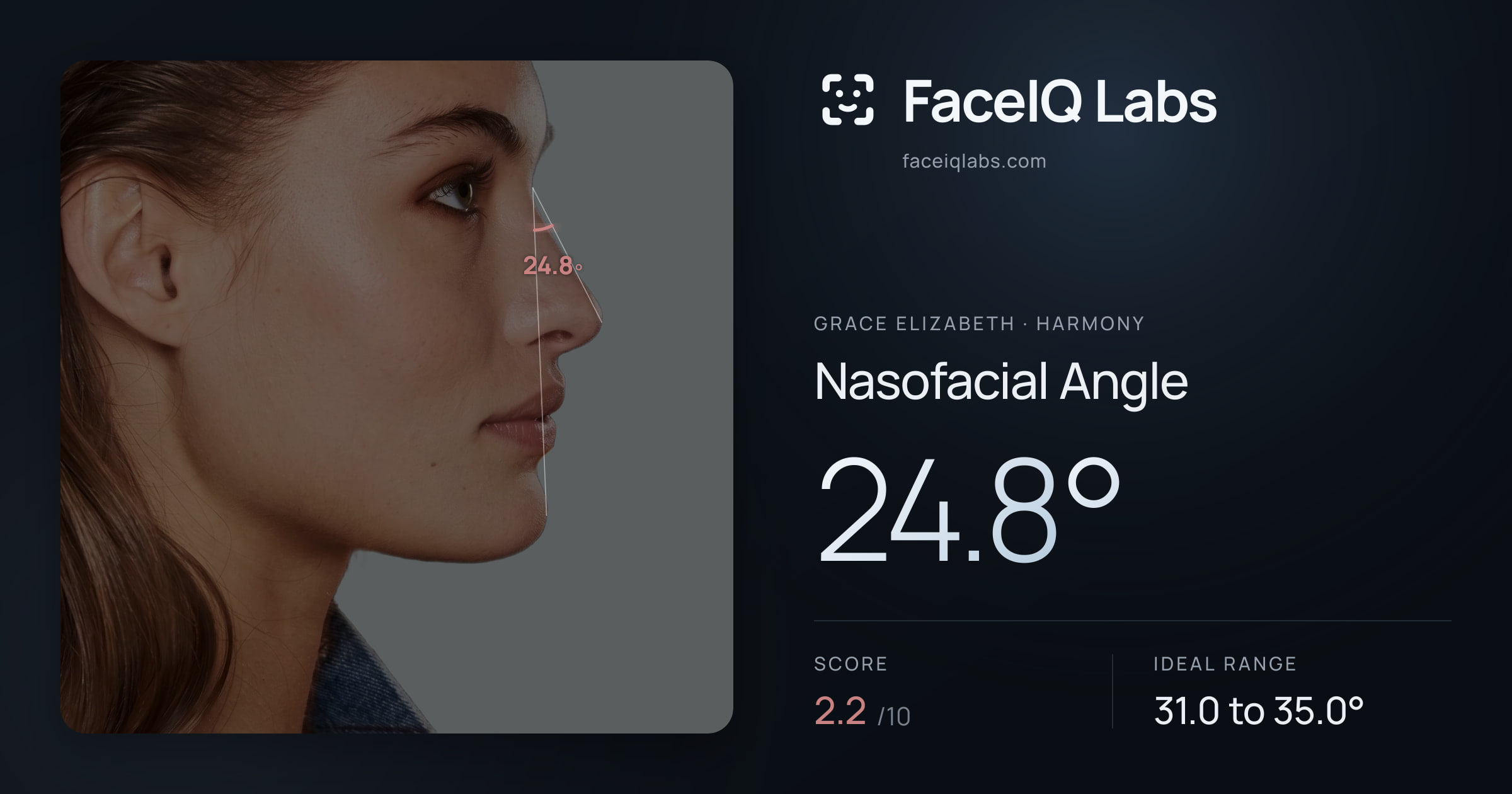 Grace Elizabeth Nasofacial Angle: 24.8°, drawn on the photo