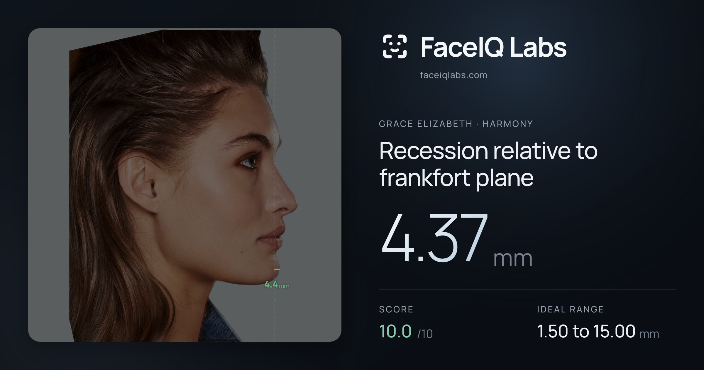 Grace Elizabeth Recession relative to frankfort plane: 4.37mm, drawn on the photo