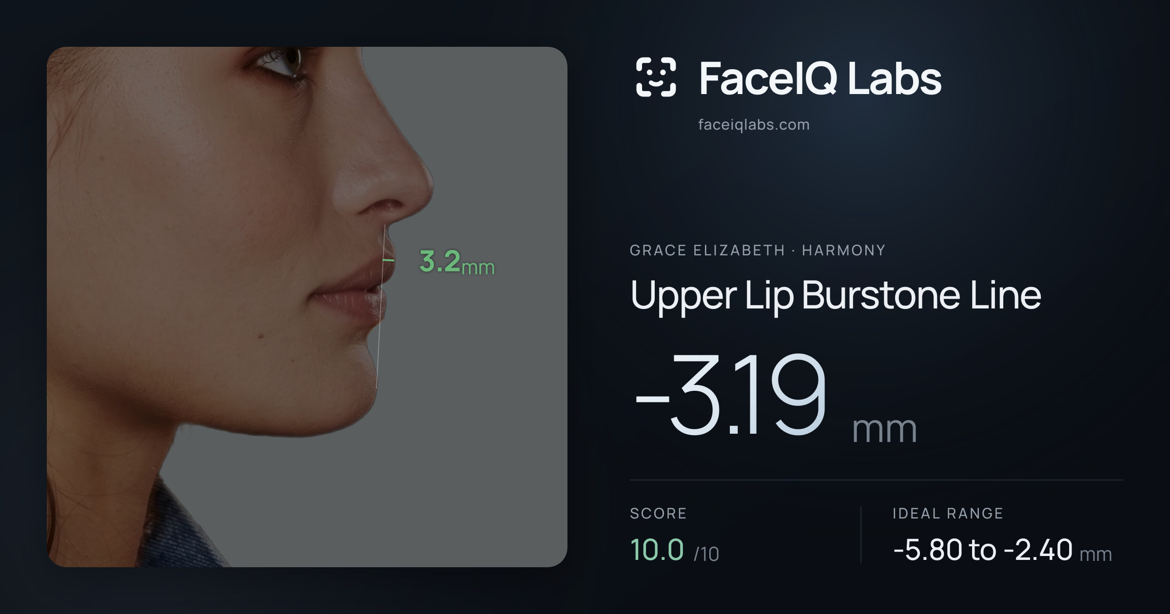 Grace Elizabeth Upper Lip Burstone Line: -3.19mm, drawn on the photo