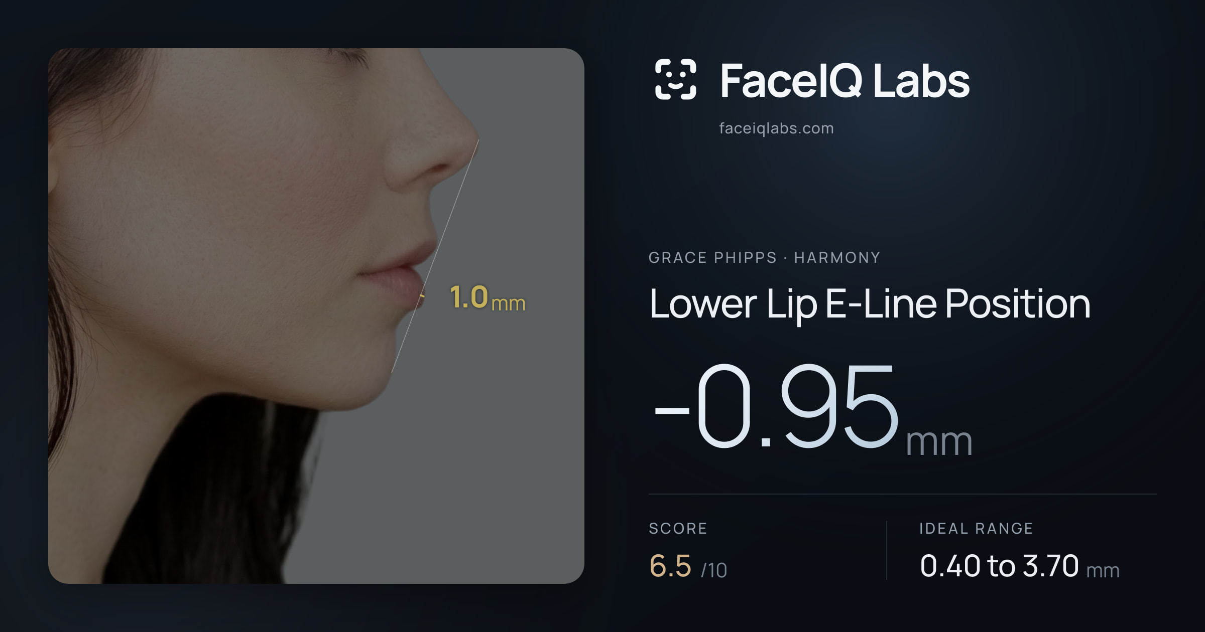 Grace Phipps Lower Lip E-Line Position: -0.95mm, drawn on the photo