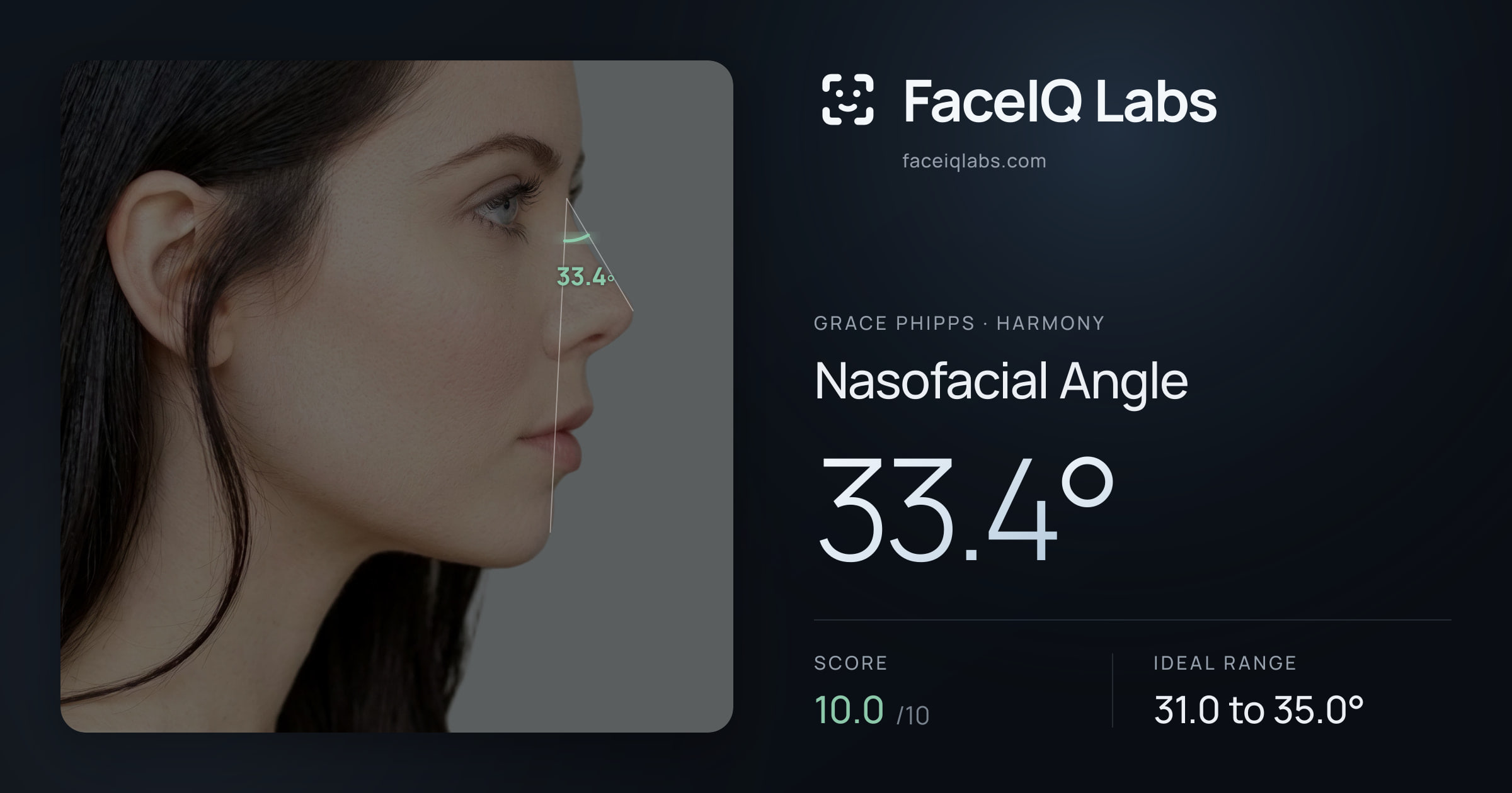 Grace Phipps Nasofacial Angle: 33.4°, drawn on the photo