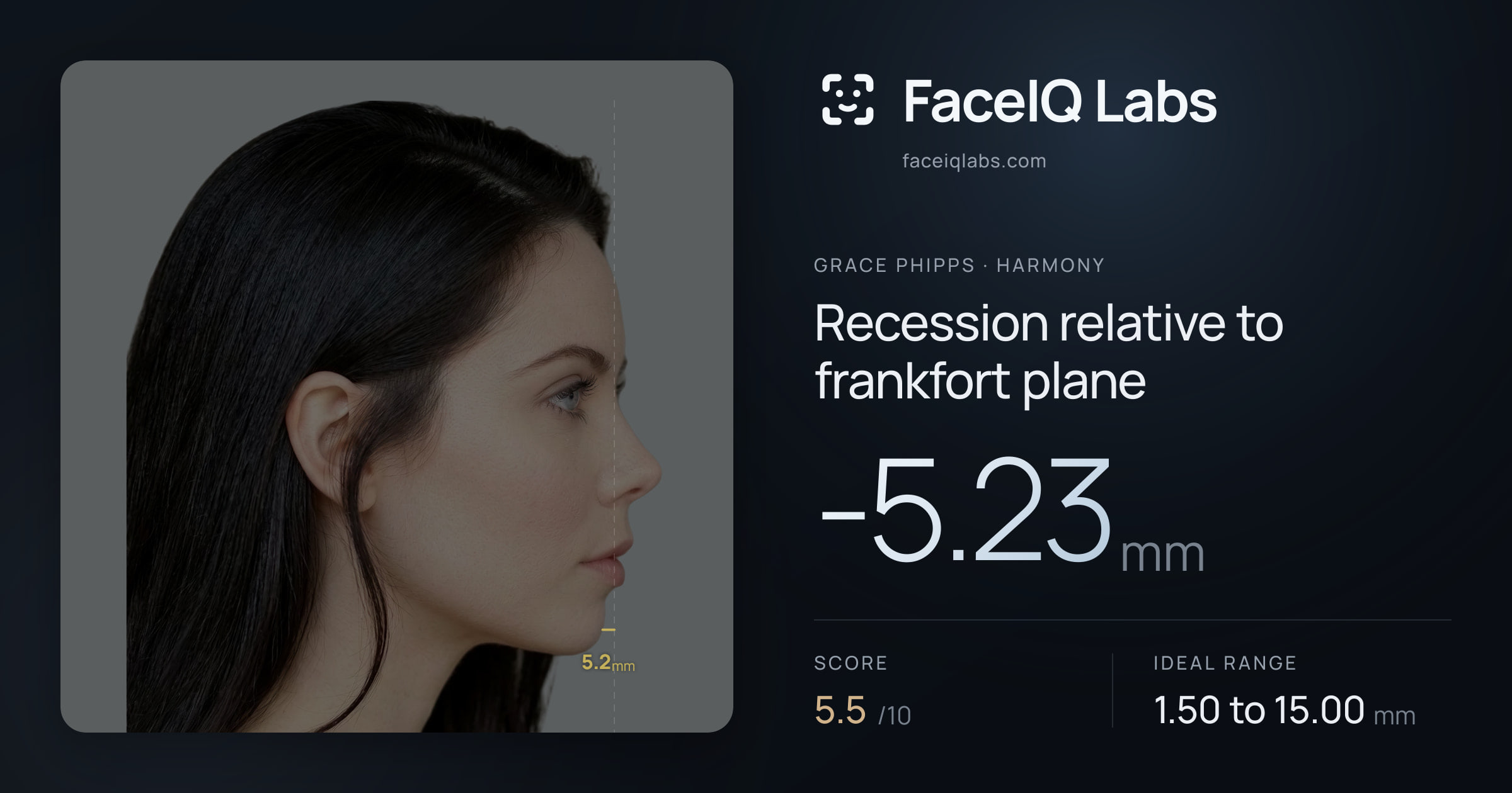 Grace Phipps Recession relative to frankfort plane: -5.23mm, drawn on the photo