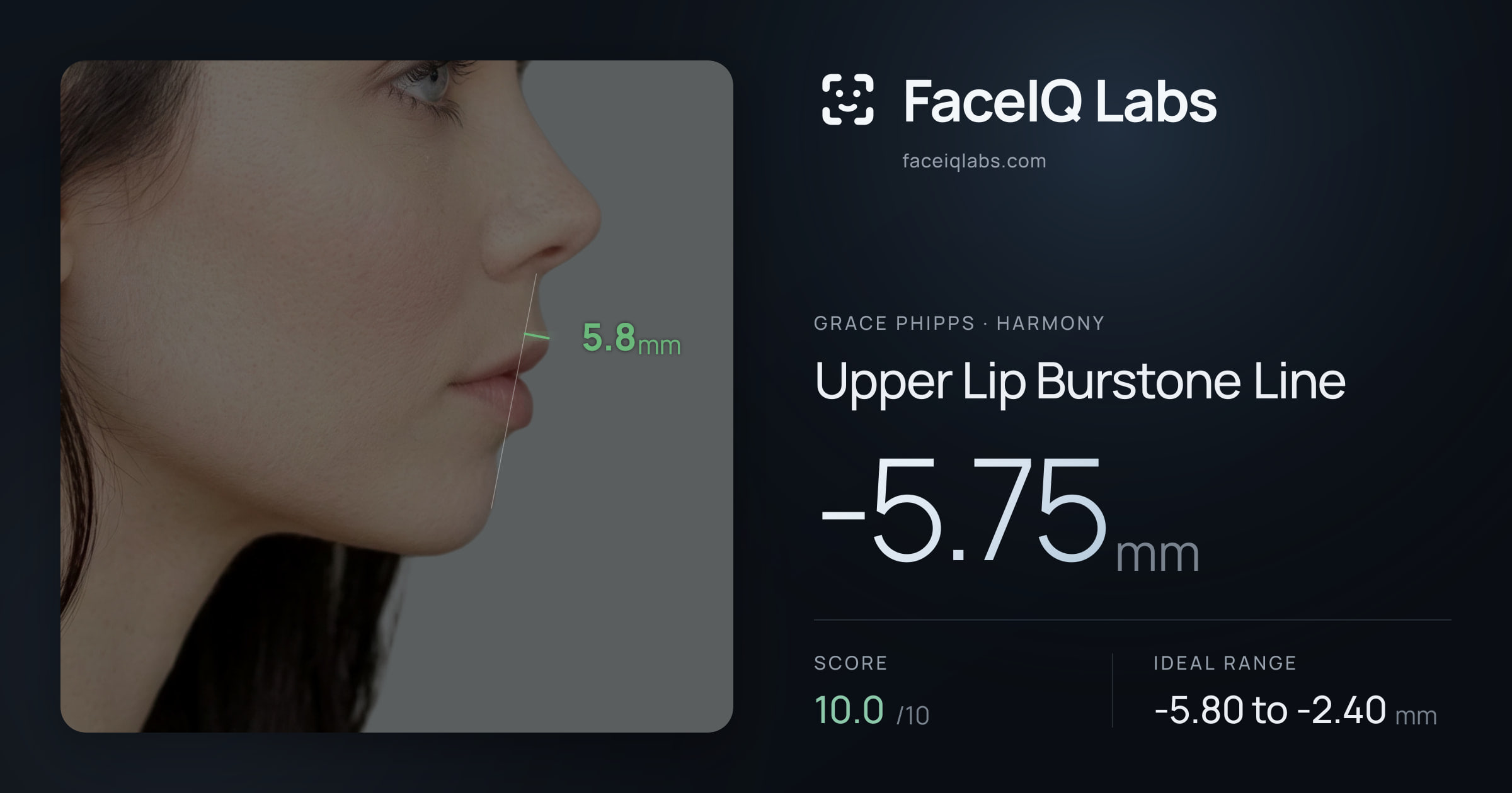 Grace Phipps Upper Lip Burstone Line: -5.75mm, drawn on the photo