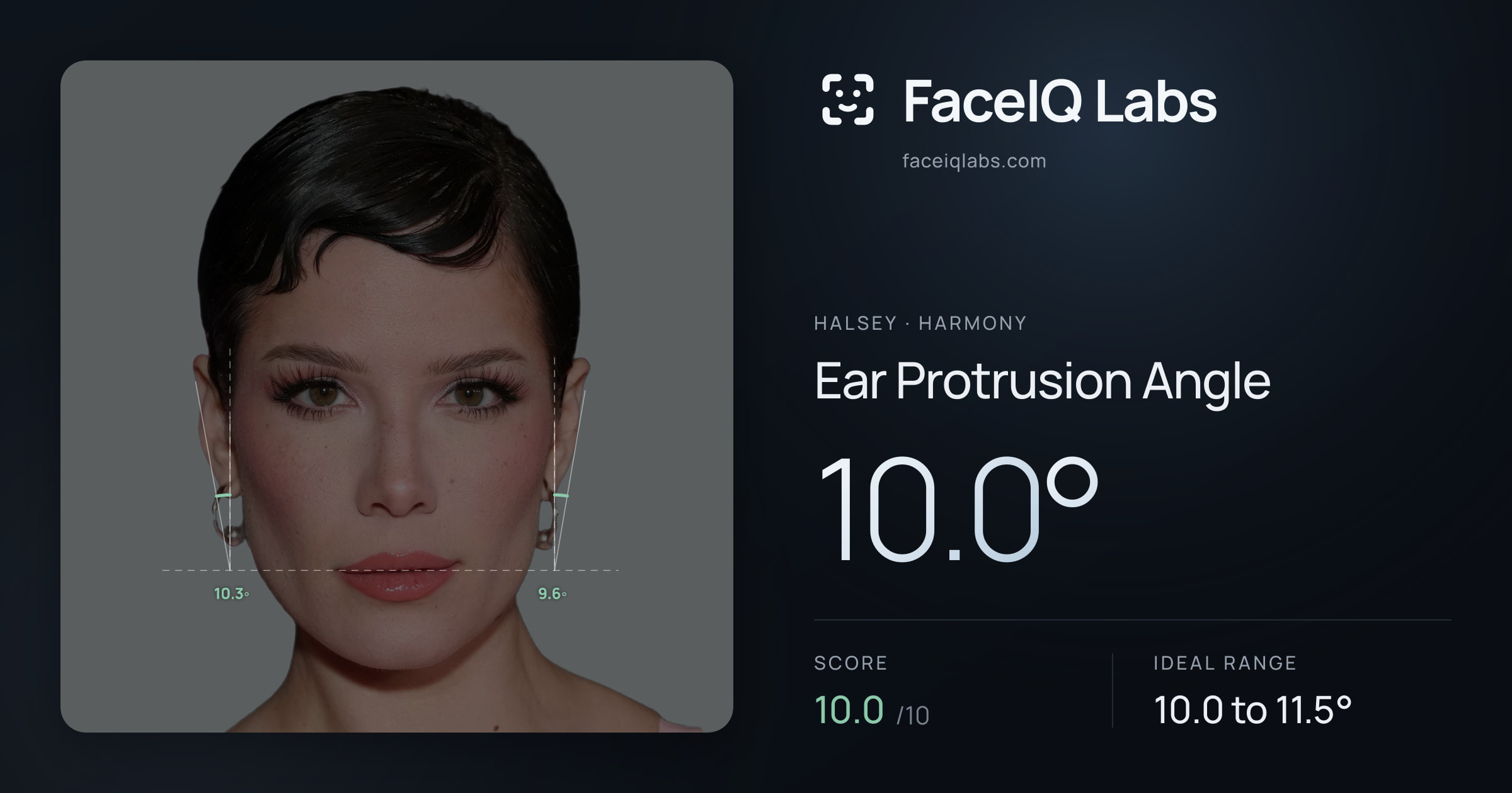Halsey Ear Protrusion Angle: 10.0°, drawn on the photo