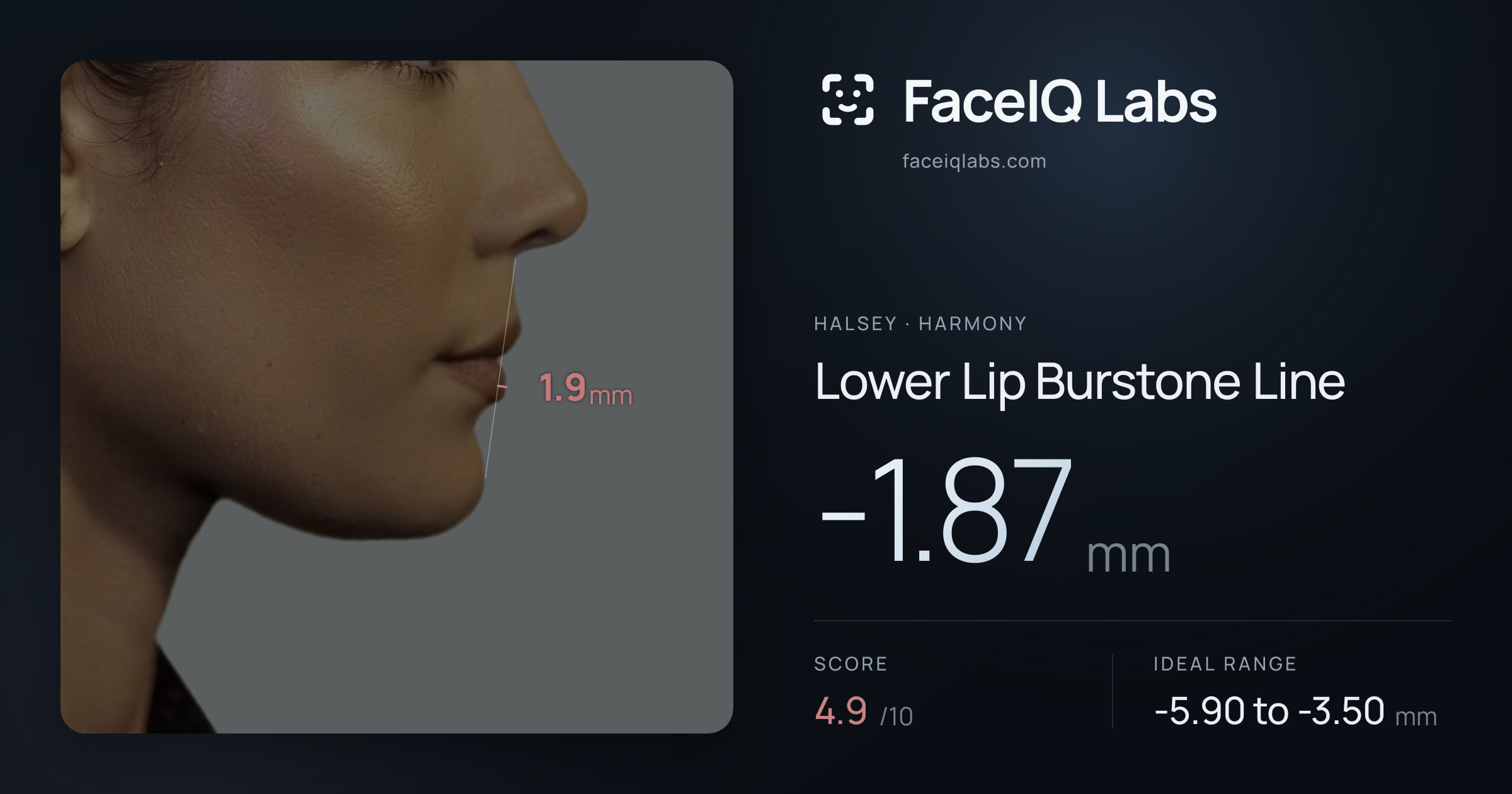 Halsey Lower Lip Burstone Line: -1.87mm, drawn on the photo