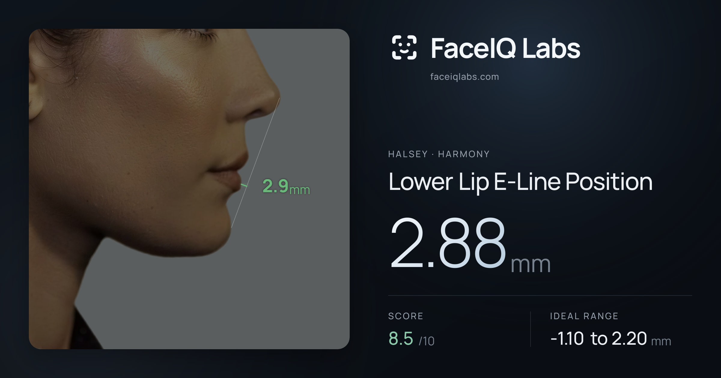 Halsey Lower Lip E-Line Position: 2.88mm, drawn on the photo